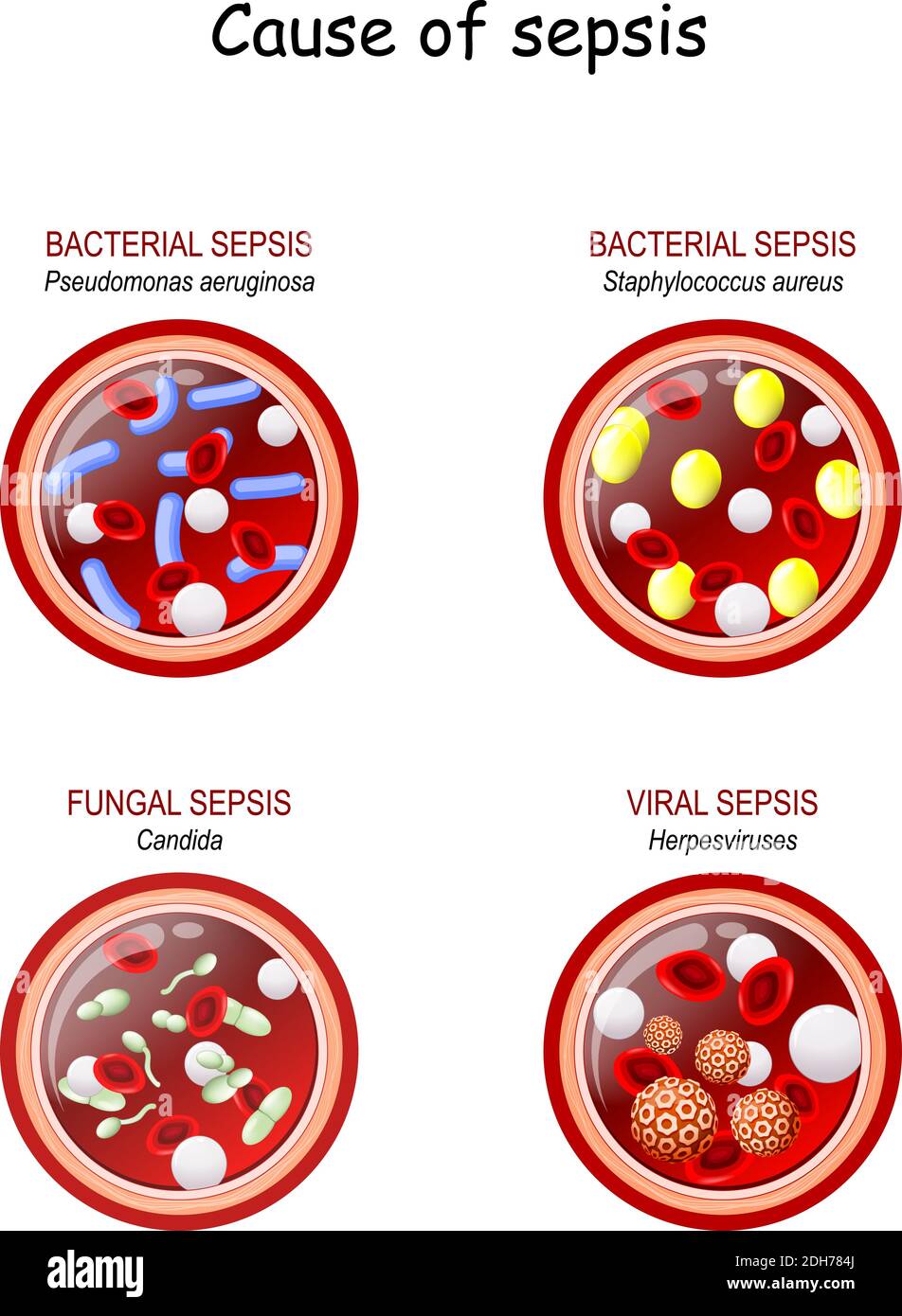 Ursache der Sepsis. Pilz (Candida) virale (Herpes) bakterielle (Staphylococcus aureus, pseudomonas aeruginosa). Nahaufnahme des Querschnitts des Blutgefäßes Stock Vektor