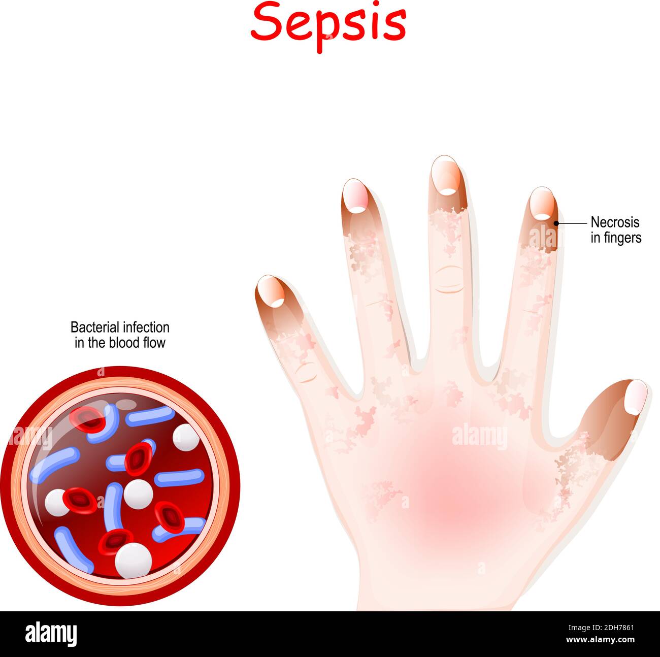 Sepsis. Nahaufnahme des Blutgefäßquerschnitts mit bakterieller Infektion. Menschliche Hand mit Fingernekrose. Vektorgrafik Stock Vektor