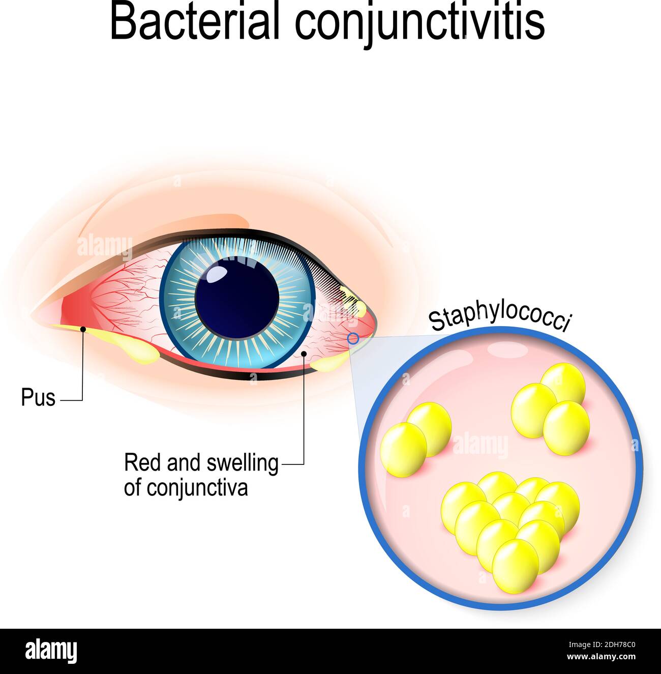 Bakterielle Konjunktivitis. Auge mit Konjunktivitis und Bakterien, die es verursachen. Staphylokokken Stock Vektor