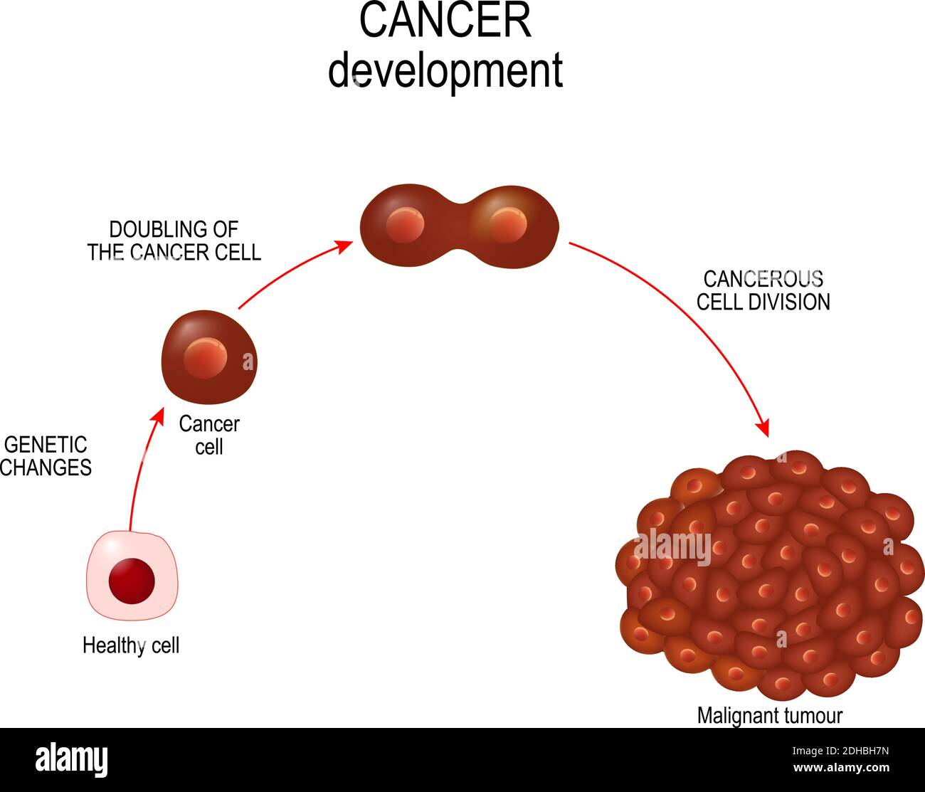 Krebszelle. Abbildung zeigt Entwicklung von Krebserkrankungen. Vektor-Diagramm für Ihr Design, Bildung, Wissenschaft und medizinische Verwendung Stock Vektor