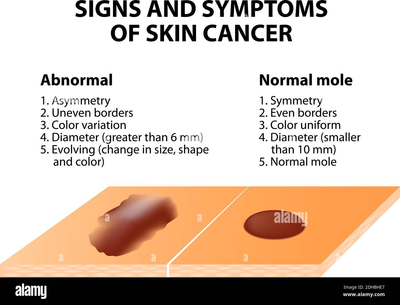 Anzeichen und Symptome von Hautkrebs. ABCDE-Richtlinie - eine einfache und einfache Möglichkeit, die Haut auf verdächtige Wucherungen zu überprüfen. Stock Vektor