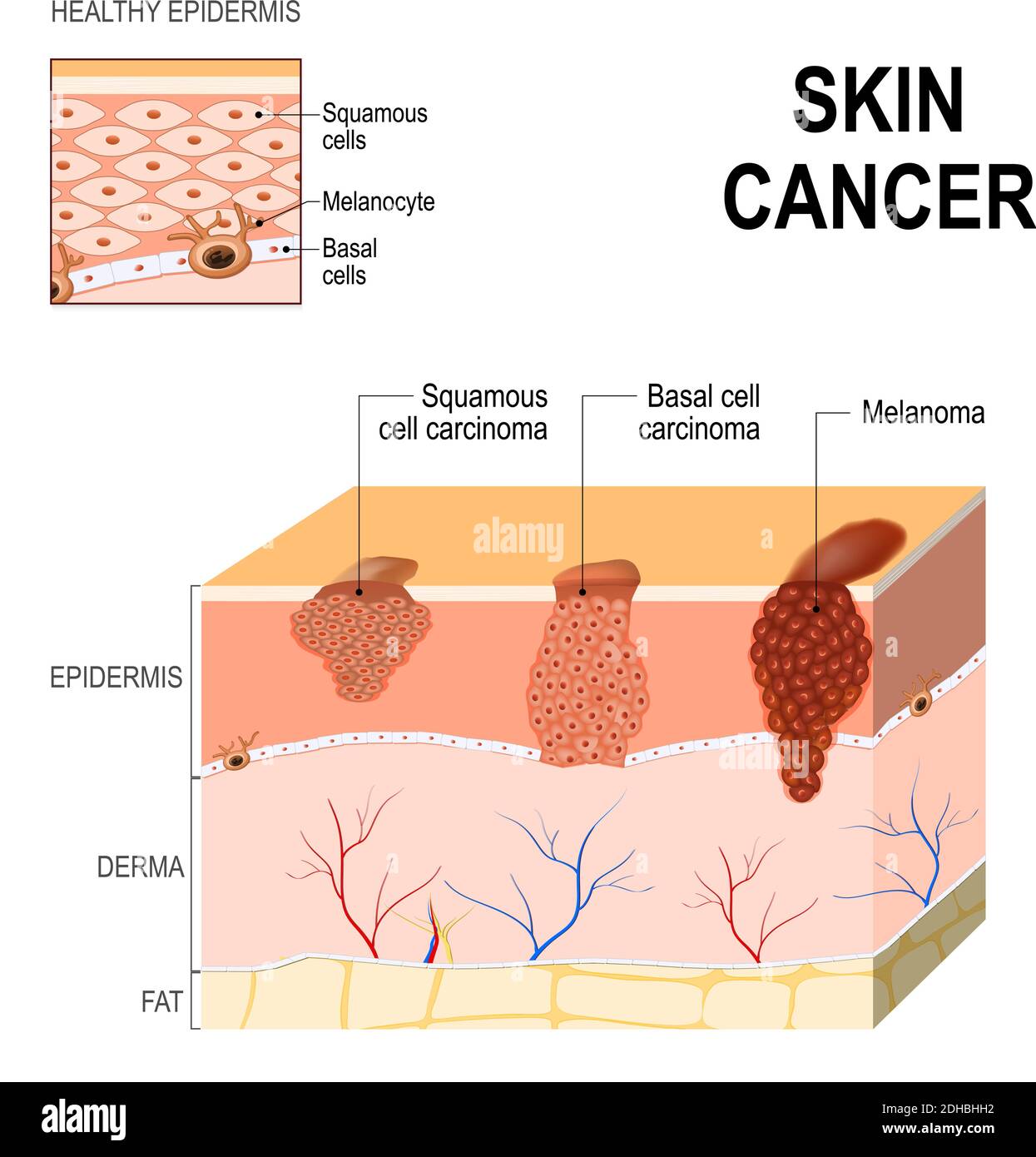 Hautkrebs: Plattenepithelkarzinom (Erkrankung älterer Zellen auf der Oberflächenhaut), Basalzellkarzinom (beginnt in den Basalzellen) und Melanom Stock Vektor