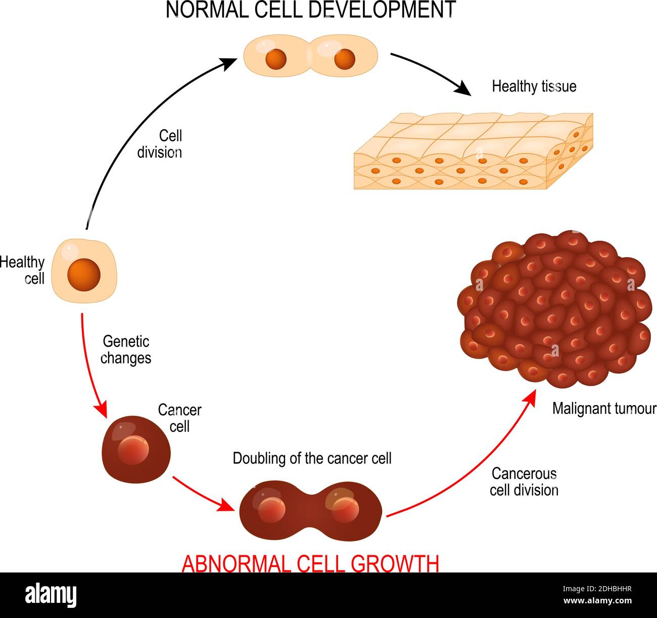 Krebszelle und normale Zelle. Gesundes Gewebe und bösartiger Tumor. Abbildung zeigt Krebs Krankheitsentwicklung. Vektordiagramm für Ihr Design Stock Vektor