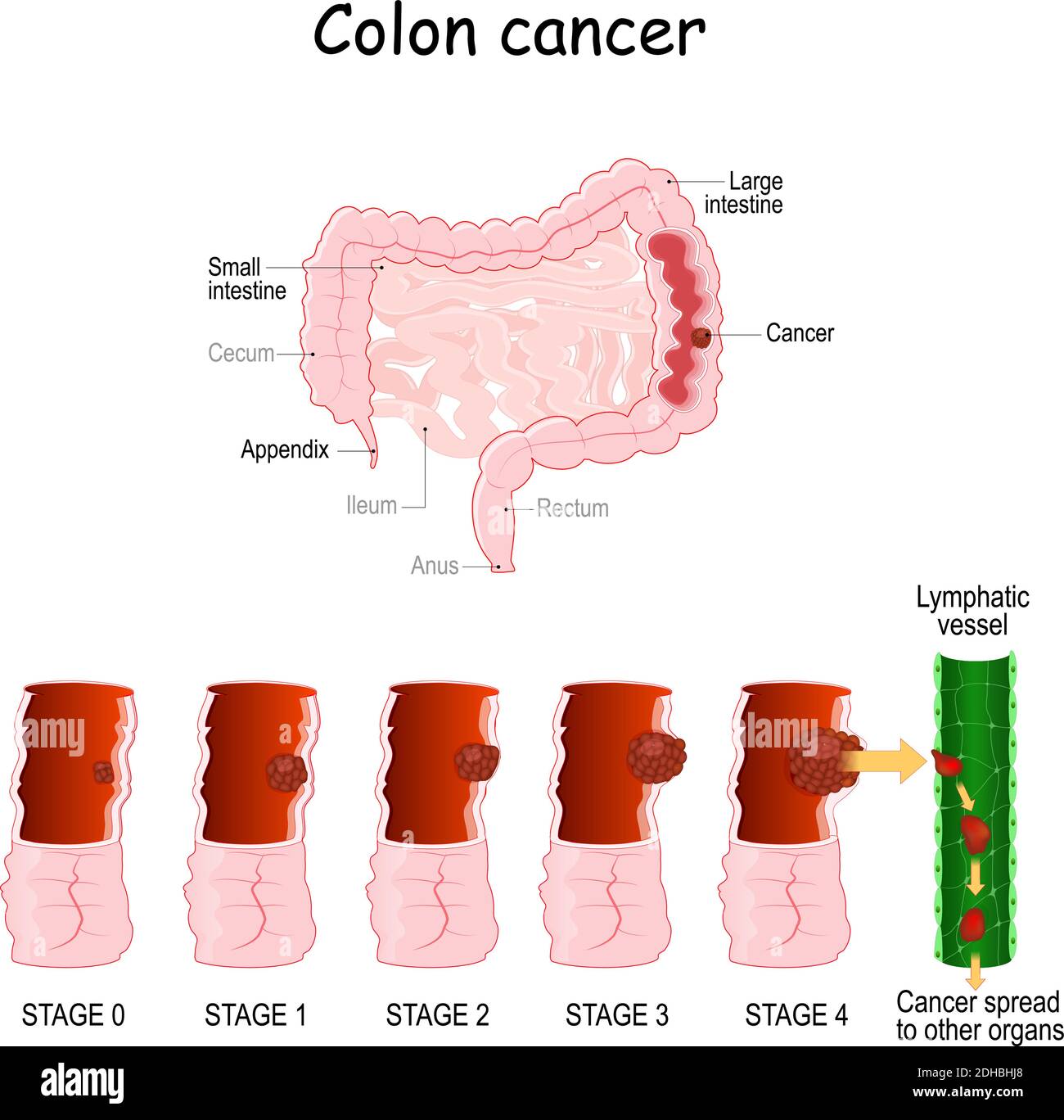 Dickdarmkrebs. Kolorektale Onkologie. Entwicklung eines bösartigen Tumors von 0 bis 4 Stufen. Medizinisches Diagramm. vektor-Abbildung. Verdauungssystem. Stock Vektor