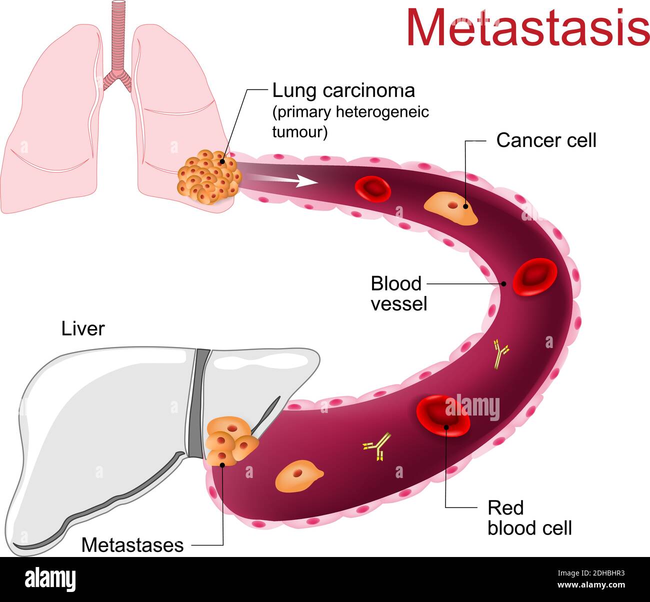 Primäre Lungenkrebs metastasieren in der Leber. Metastasen oder Metastasen Stock Vektor