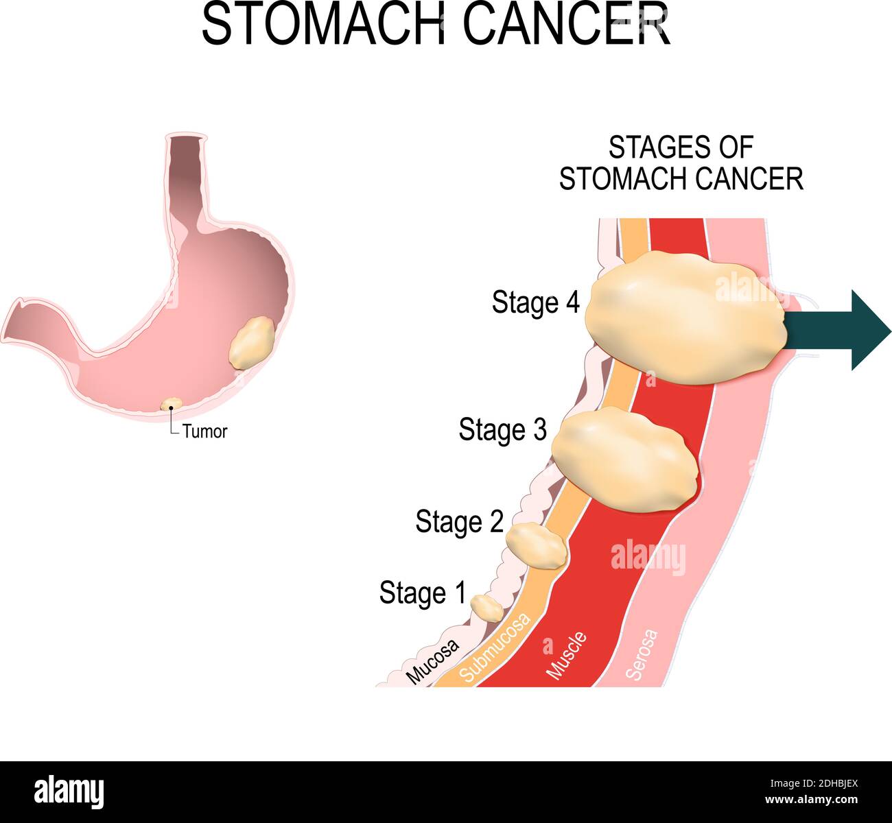 Die klinischen Stadien von Magenkrebs. Klassifizierung maligner Tumoren. Vektorgrafik für den medizinischen Gebrauch Stock Vektor