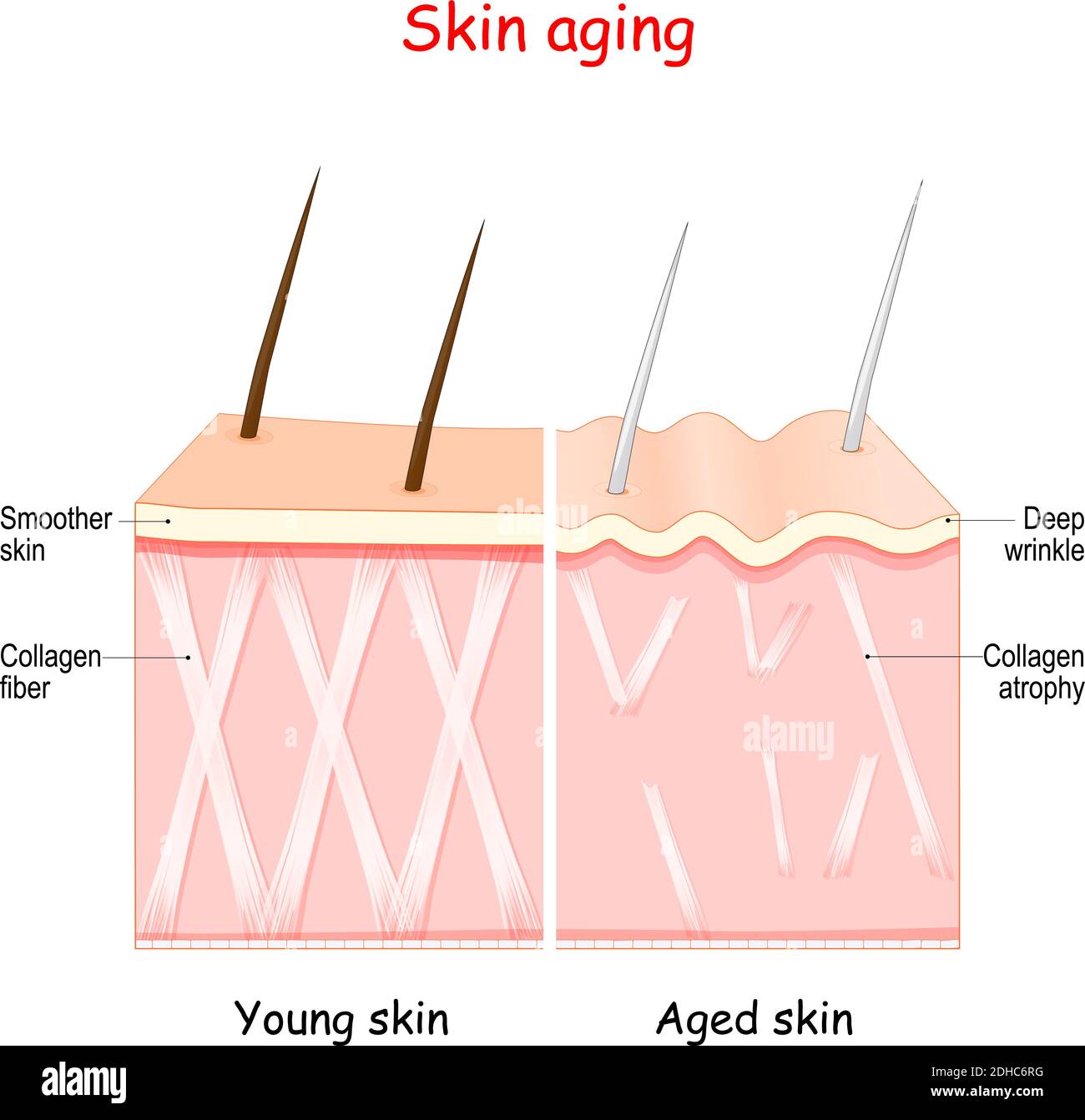 Alterungsprozess in der Haut. Altersbedingte Veränderungen. Kollagen und Falten Stock Vektor
