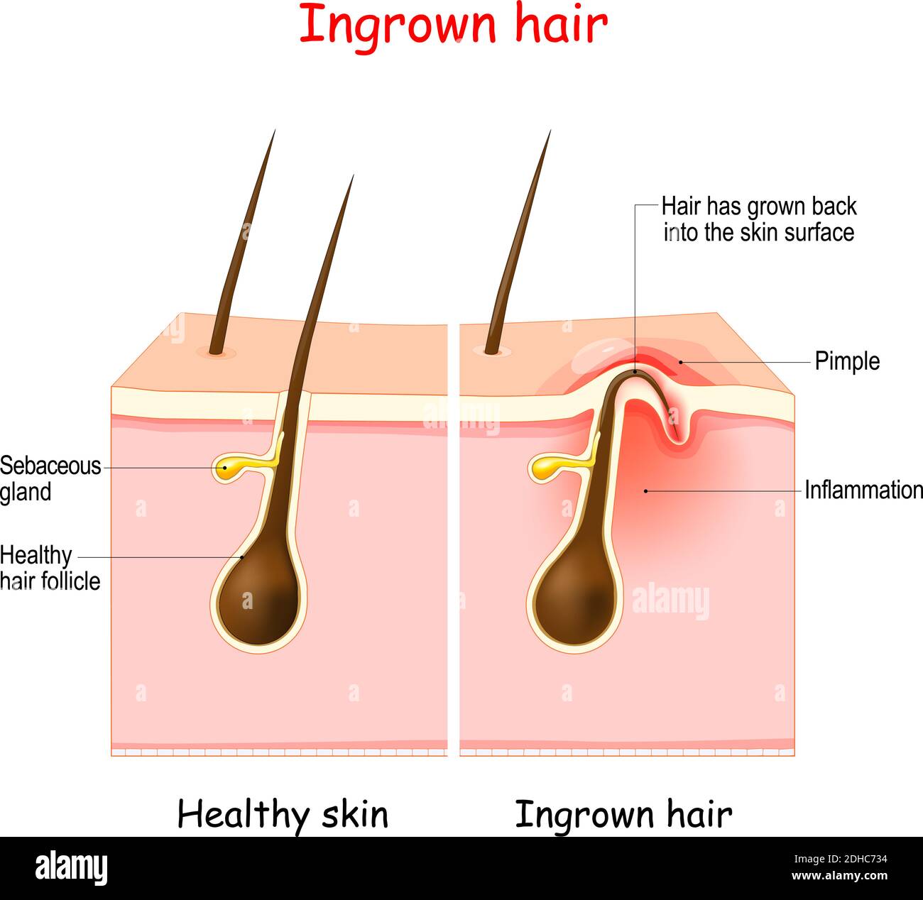 Eingewachsene Haare nach Haarentfernung und Rasur. Vergrabene Haare. Struktur des Haarfollikels. Vektorgrafik Stock Vektor