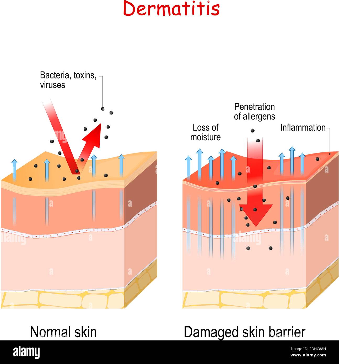 Dermatitis. Normal und Haut mit geschädigter Barriere. Schutzwirkung. Der Unterschied zwischen gesunder und trockener Haut Stock Vektor