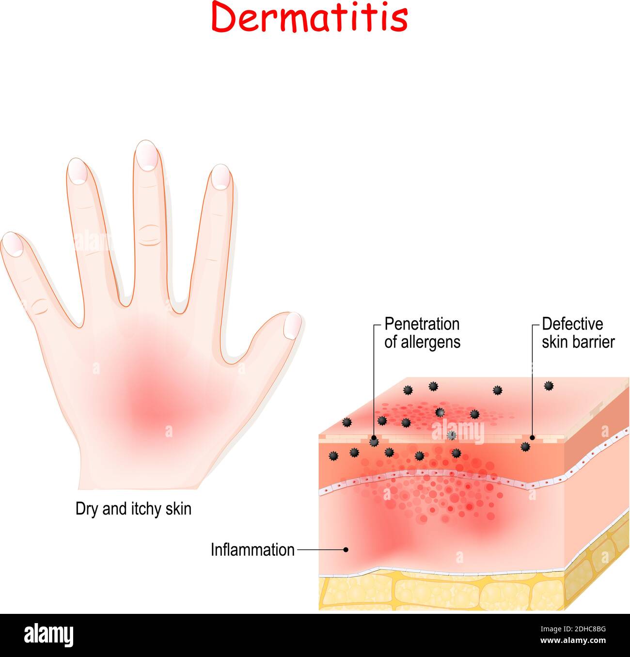 Dermatitis. Atopisches Ekzem. Nahaufnahme des Querschnitts der menschlichen Haut mit Dermatitis. Eindringen von Allergenen. Vektorgrafik Stock Vektor