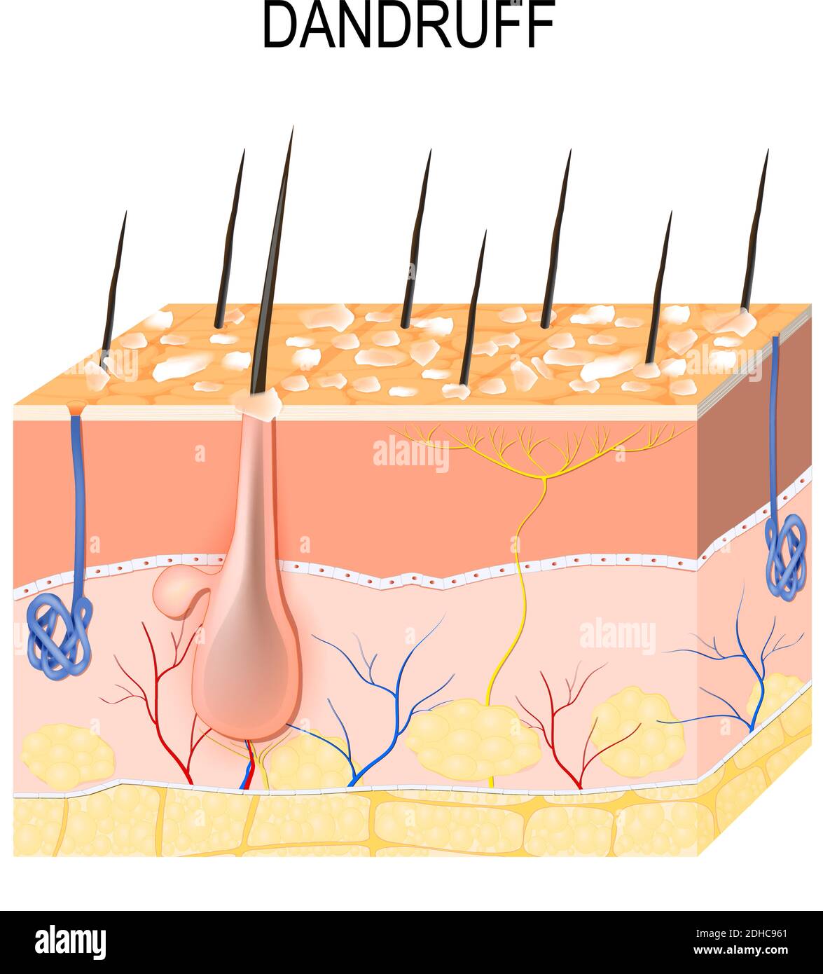 Schuppen. Seborrhoische Dermatitis kann durch trockene Haut, Bakterien und Pilze auf der Kopfhaut auftreten. Es verursacht die Bildung von trockenen Hautflocken auf der Kopfhaut Stock Vektor