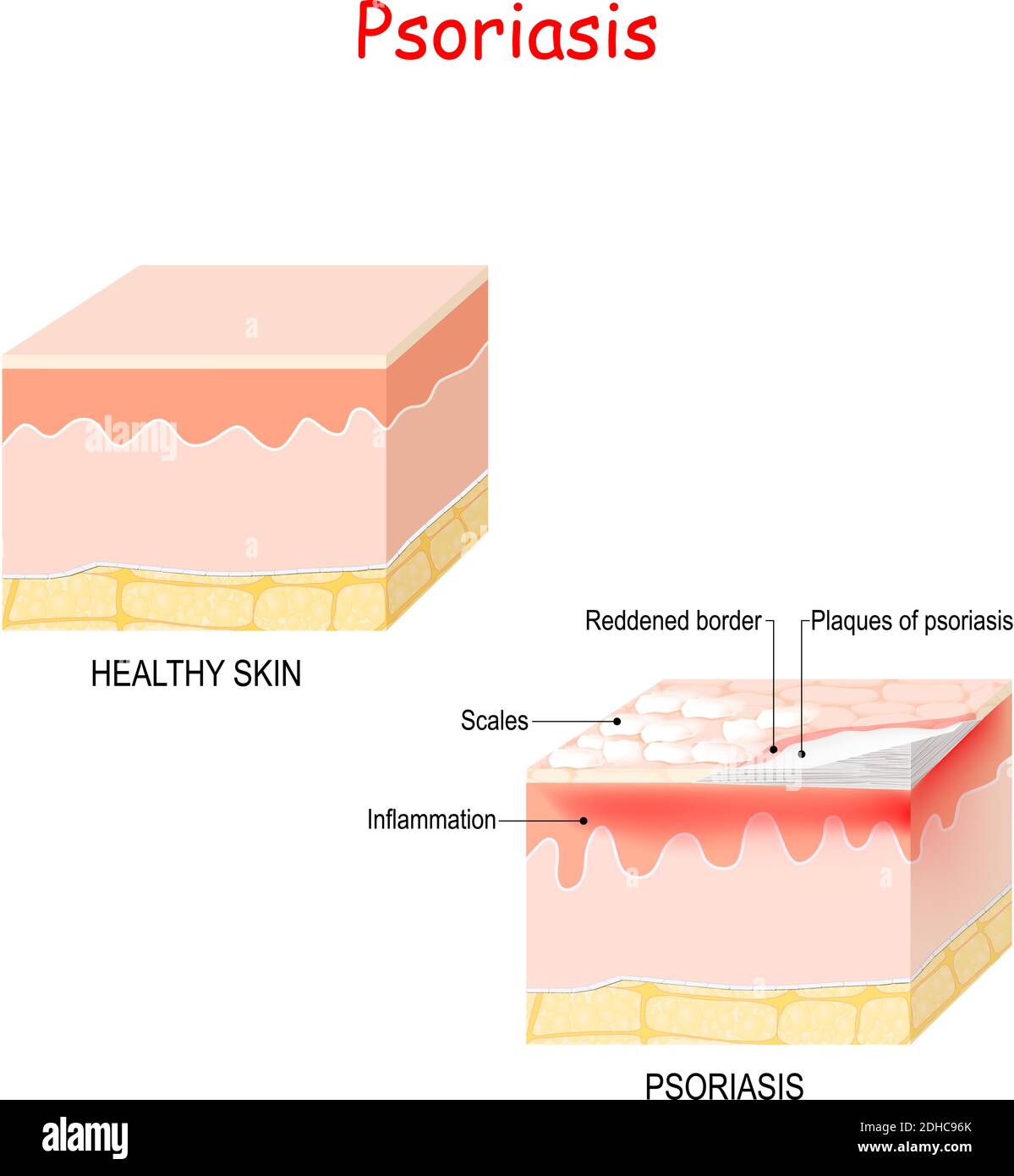 Normale Haut und Psoriasis. Anzeichen und Symptome Hauterkrankung. Stock Vektor