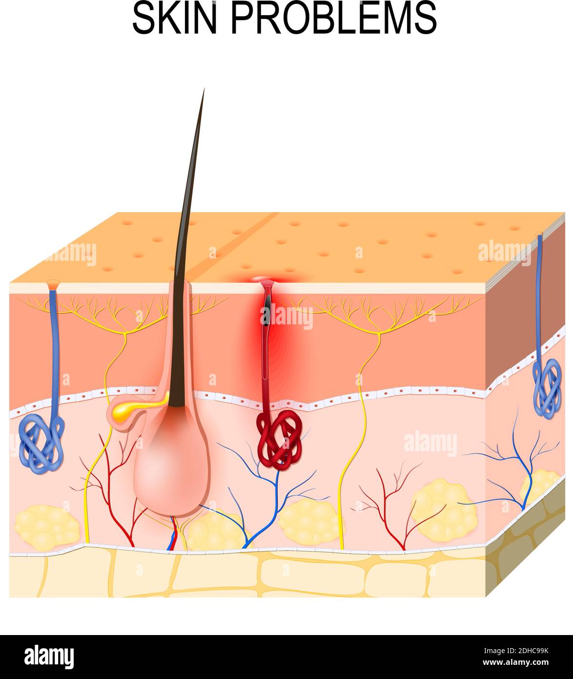 Hautprobleme. Verstopfte Poren. Sebum und abgestorbene Hautzellen in der verstopften Pore fördern das Wachstum bestimmter Bakterien (Propionibacterium acnes) Stock Vektor