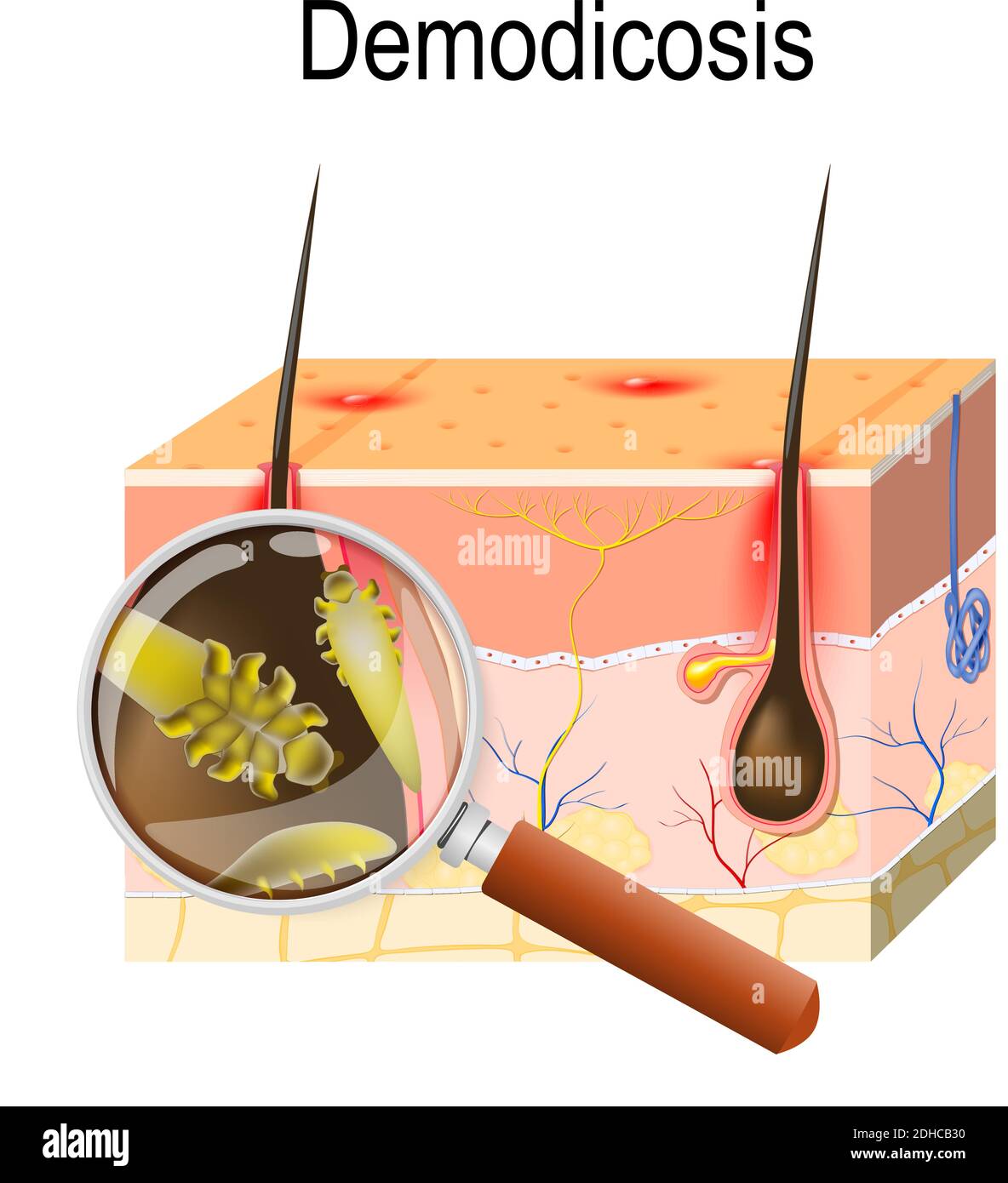 Demodikose, sogenannte demodektische Mähne oder rote Mähne. Querschnitt der Haut mit Milben. Nahaufnahme Demodex durch Lupe Stock Vektor