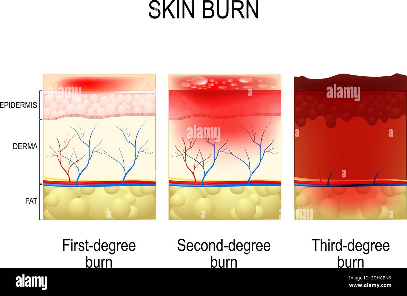 Hautverbrennungen. Schichten der Haut. Erste, zweite und dritte Grad der Haut Verbrennungen Stock Vektor