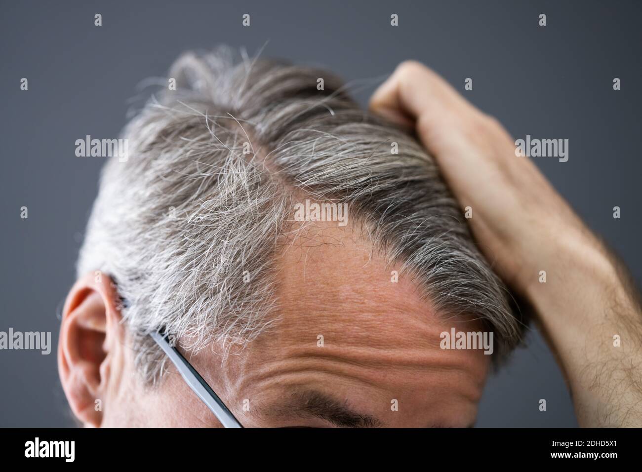 Glatzen Mann Haar Verlieren. Überprüfung Des Haarverlustes Der Kopfhaut Stockfoto