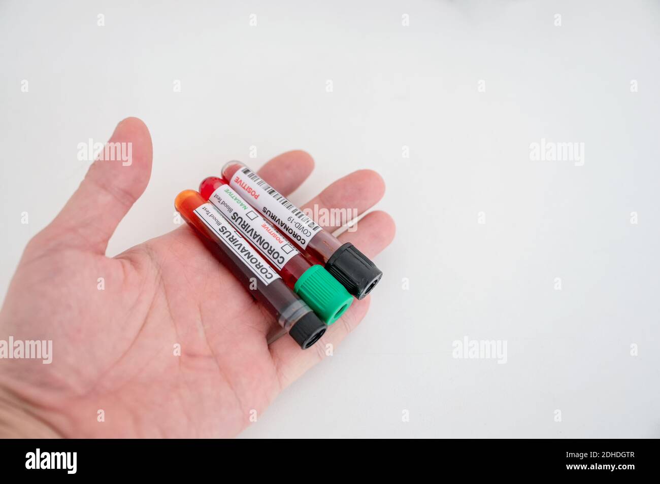 Probe von Blutproben auf der Handfläche des Chemikers zur Diagnose Coronavirus, Covid-19-Infektion im Labor Stockfoto