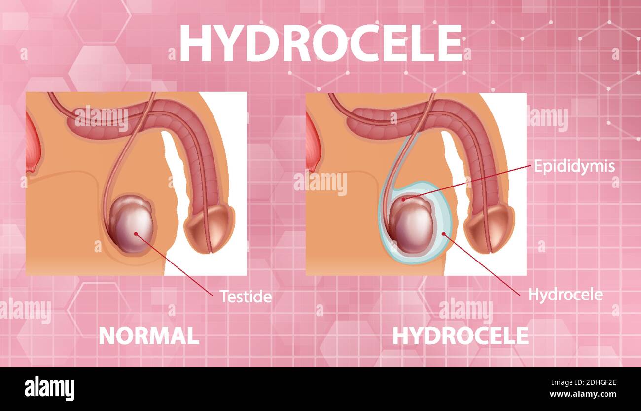 Medizinisches Poster zeigt verschiedene männliche normale Hoden und Hydrozele Abbildung Stock Vektor