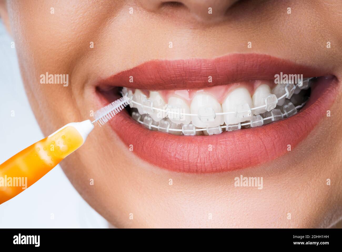 Weibliche Reinigung Zahnhalterungen Im Mund Mit Zahnbürste Stockfoto