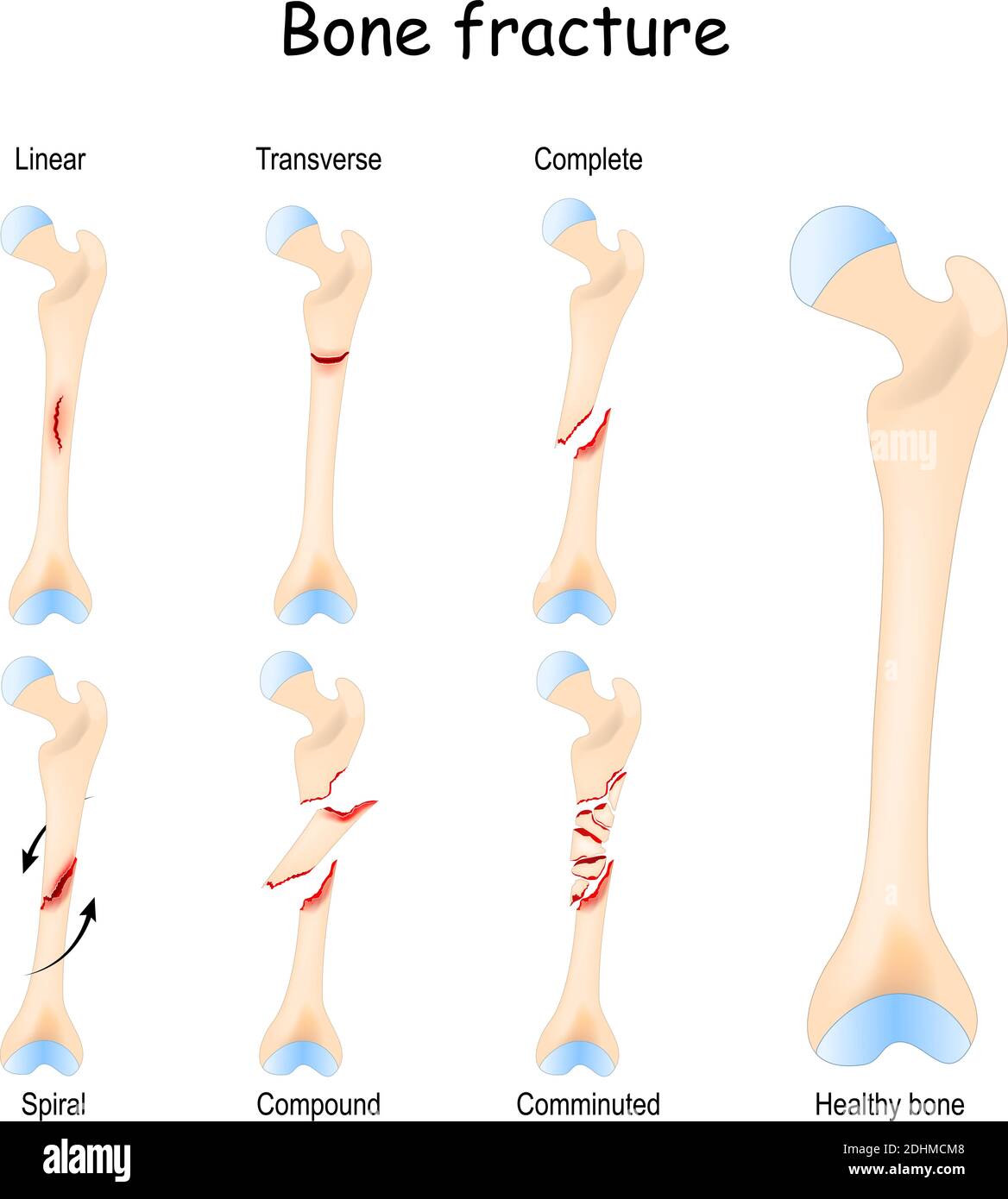 Typische Knochenbrüche: Linear, transversal, komplett, Compound, Spiral und Komputur. Gesunde Oberschenkel- und Beinfraktur in verschiedenen Stadien. Stock Vektor