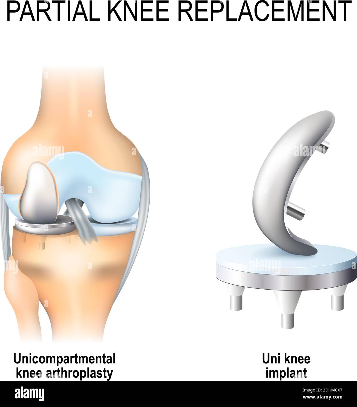 Partieller Knieersatz. Einfachknieartroplastik und Einknieimplantat Stock Vektor