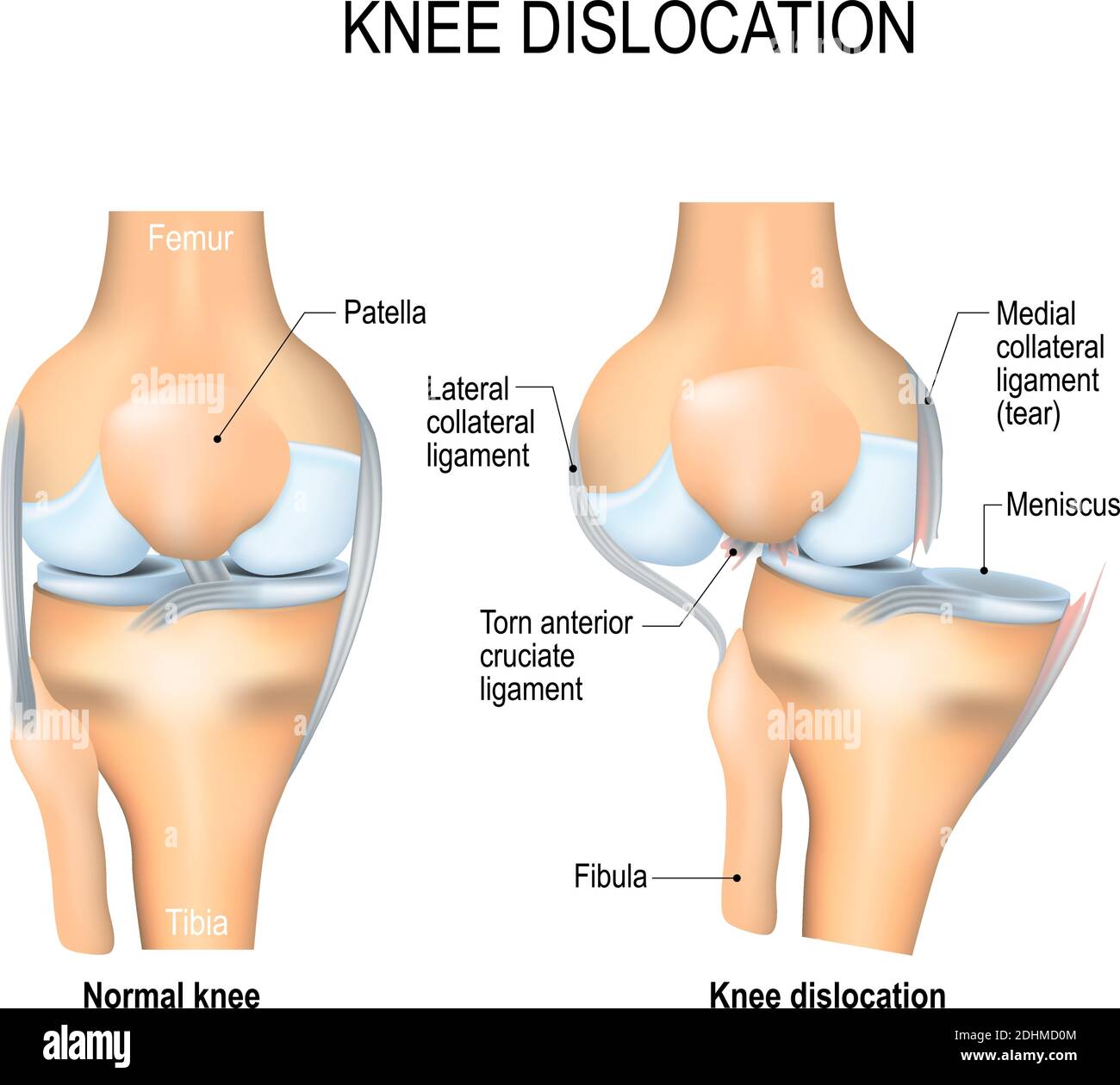 Knieverfall und normal. Seitliche Traumata zum Knie, zerrissene Seitenbänder, Kreuzbandverletzung und Meniskusverletzung. Menschliche Anatomie Stock Vektor Knieverfall und normal. Seitliche Traumata zum Knie, zerrissene Seitenbänder, Kreuzbandverletzung und Meniskusverletzung. Menschliche Anatomie Stock Vektor