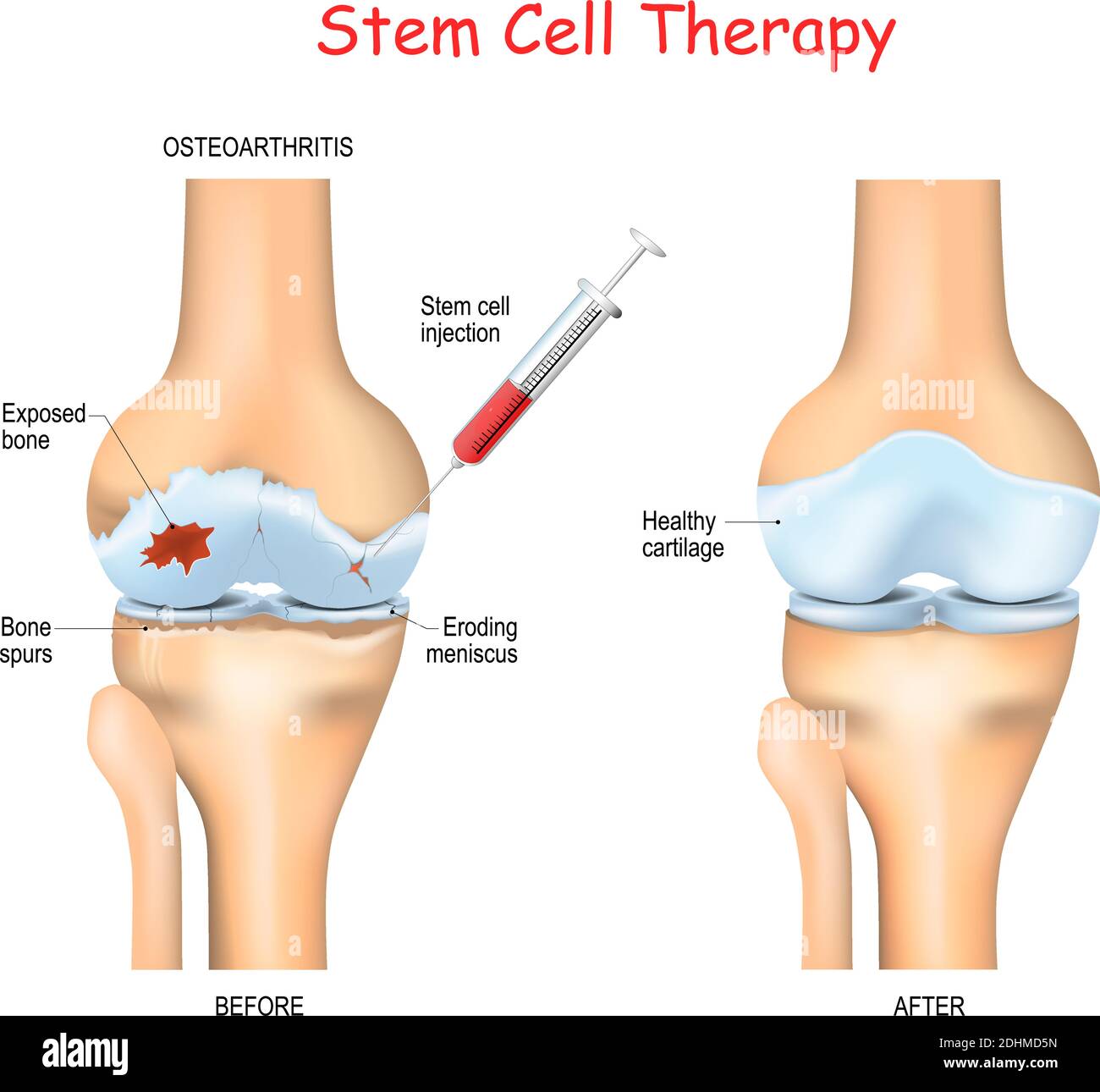 Stammzelltherapie bei Schmerzen bei Arthrose, Knie und Hüften Nutzen Sie die heilenden Eigenschaften Ihrer eigenen Zellen, die aus Knochenmark oder Fettfett gewonnen werden Stock Vektor