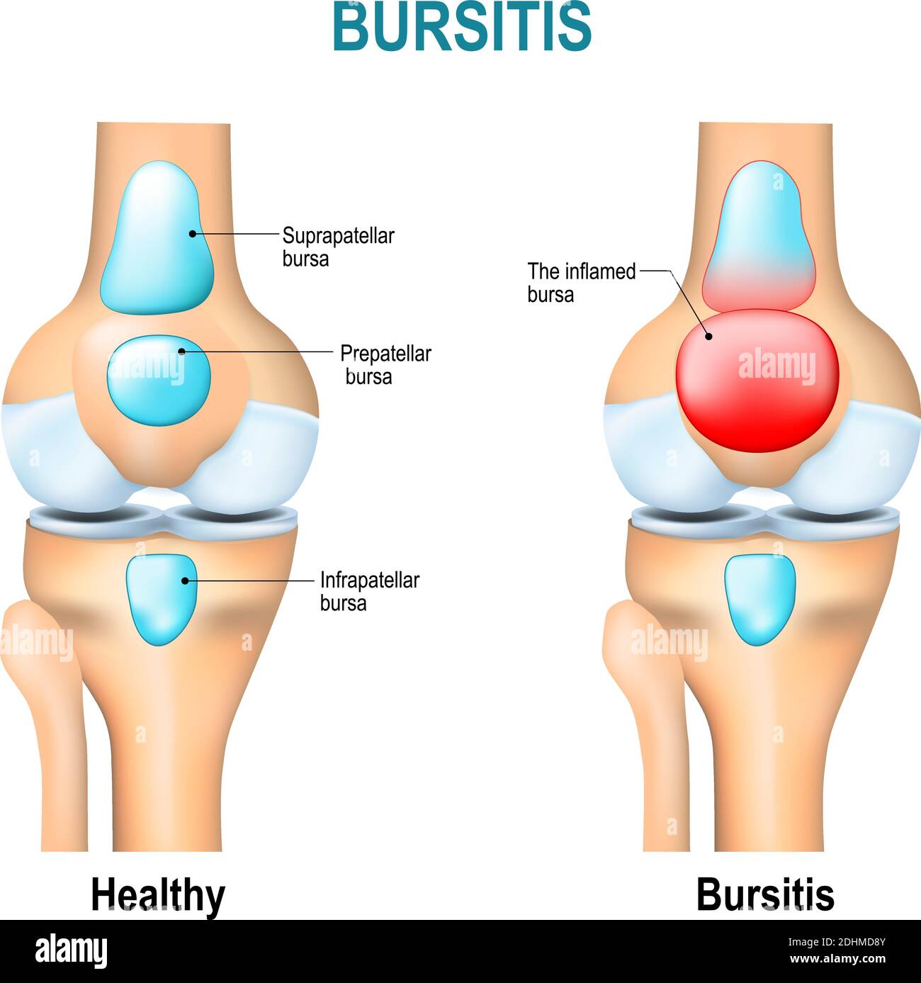 Bursitis. Gesunde Knie und Knie des Menschen mit Entzündung der Bursae (Synovialflüssigkeit). Stock Vektor