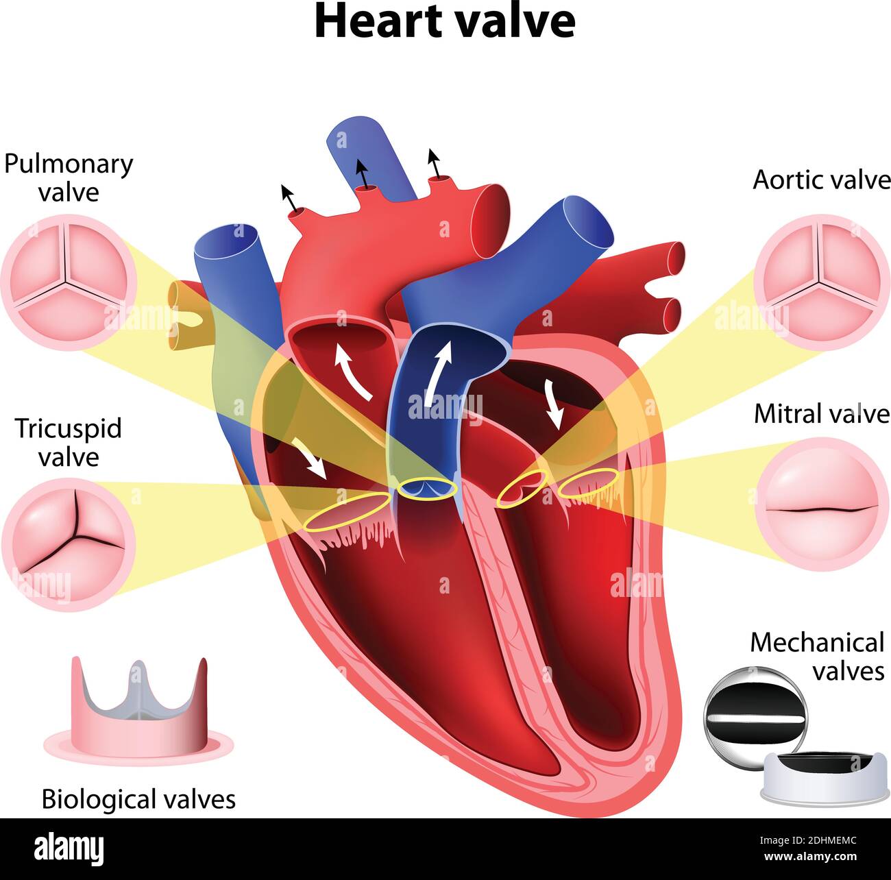Herzklappenchirurgie. Lungen-, Tricuspid-, Aortenklappe und Mitralklappe. Biologische Ventile und mechanische Ventile Stock Vektor
