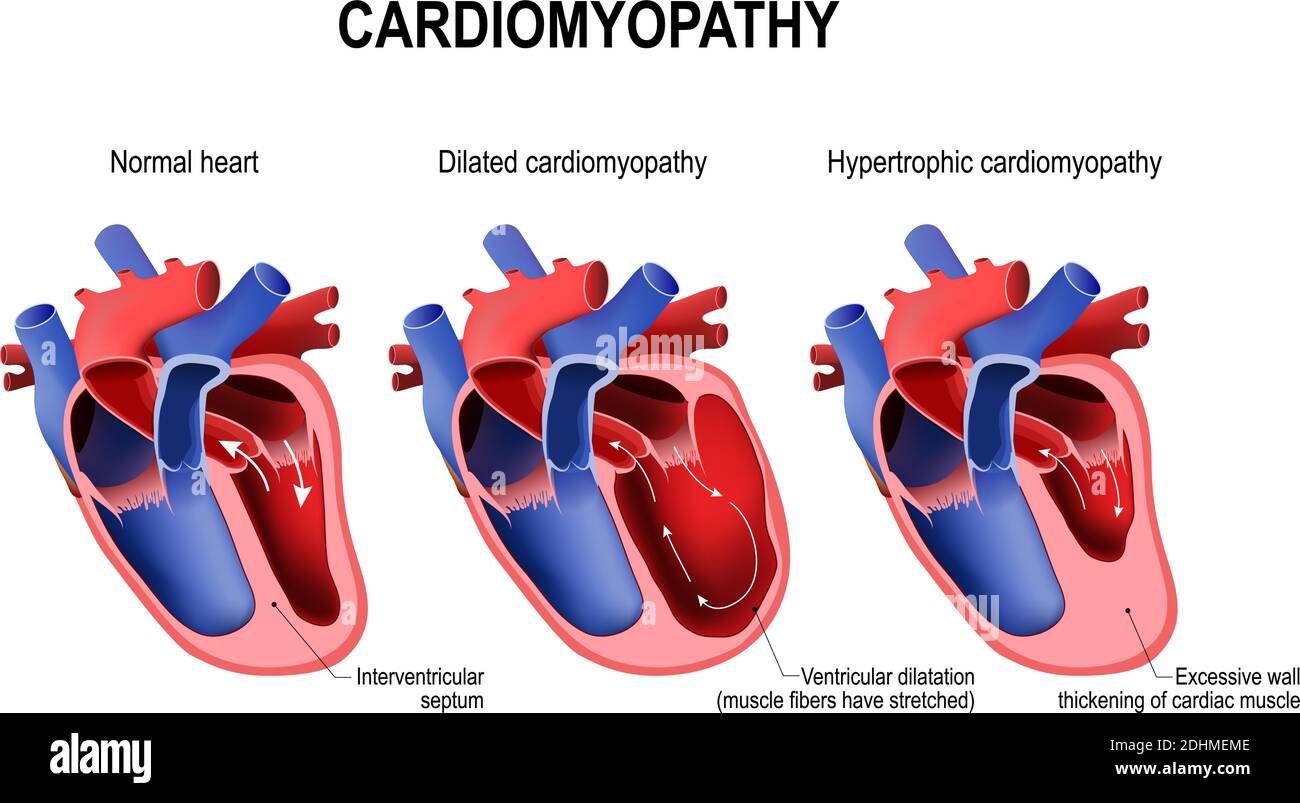 Arten von Herzerkrankungen: Hypertrophe Kardiomyopathie und erweiterte Kardiomyopathie. Gesundes Herz und Herz mit Pathologie. vektor-Illustration Stock Vektor