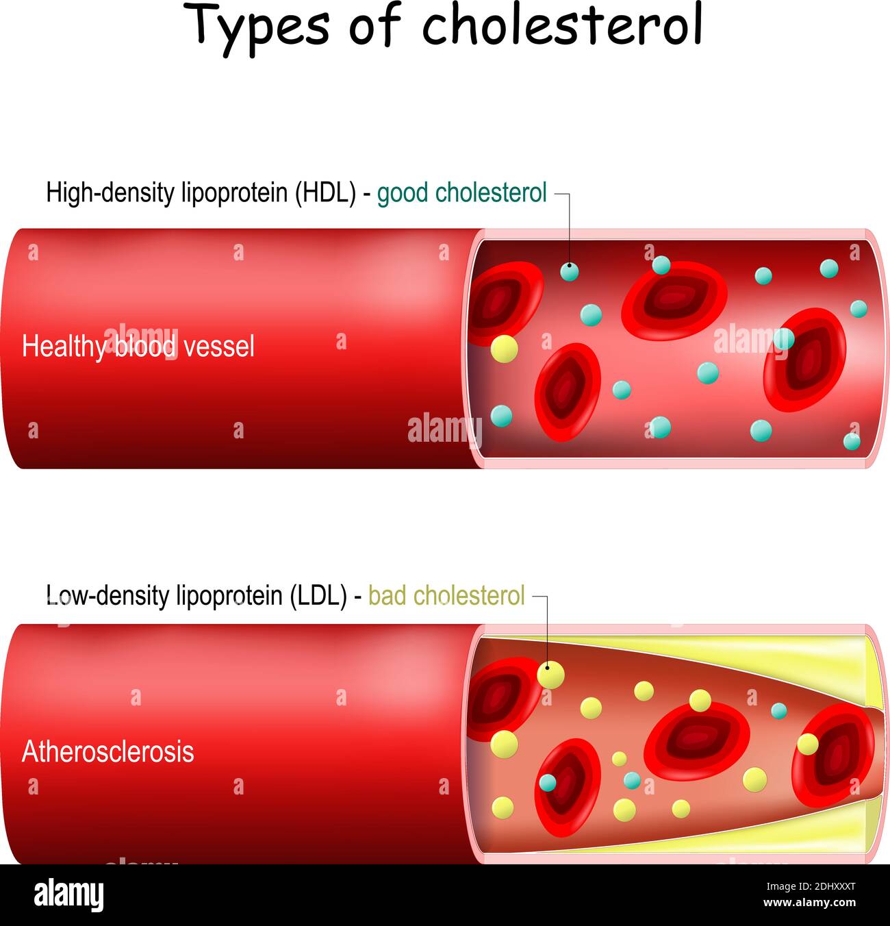 Arten von Cholesterin. Gutes (HDL) und schlechtes (LDL) Cholesterin. Gesunde Blutgefäße und Atherosklerose. Querschnitt des Blutgefäßes mit Erythrozyten Stock Vektor