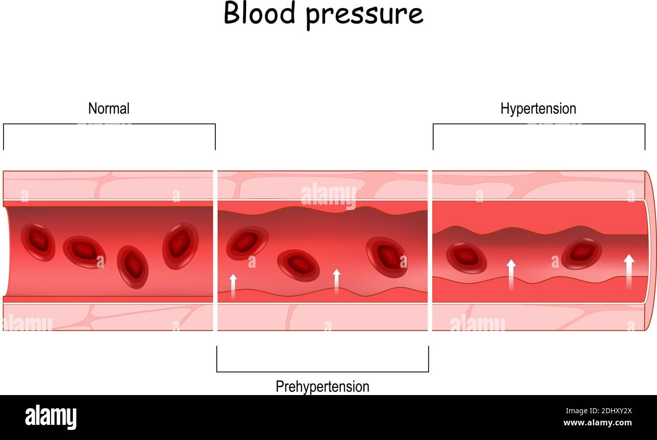 Bluthochdruck. Hoher Blutdruck. Querschnitt des Blutgefäßes mit roten Blutkörperchen. Vergleich von Prähypertonie, Hypertonie und normalem Blut Stock Vektor