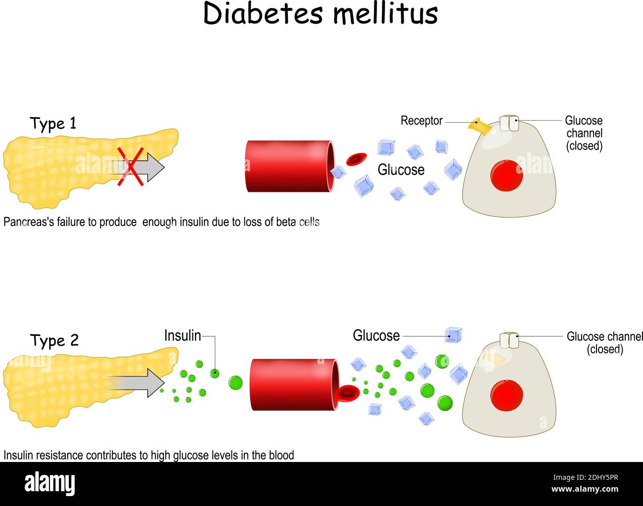 Arten von Diabetes mellitus. Stock Vektor