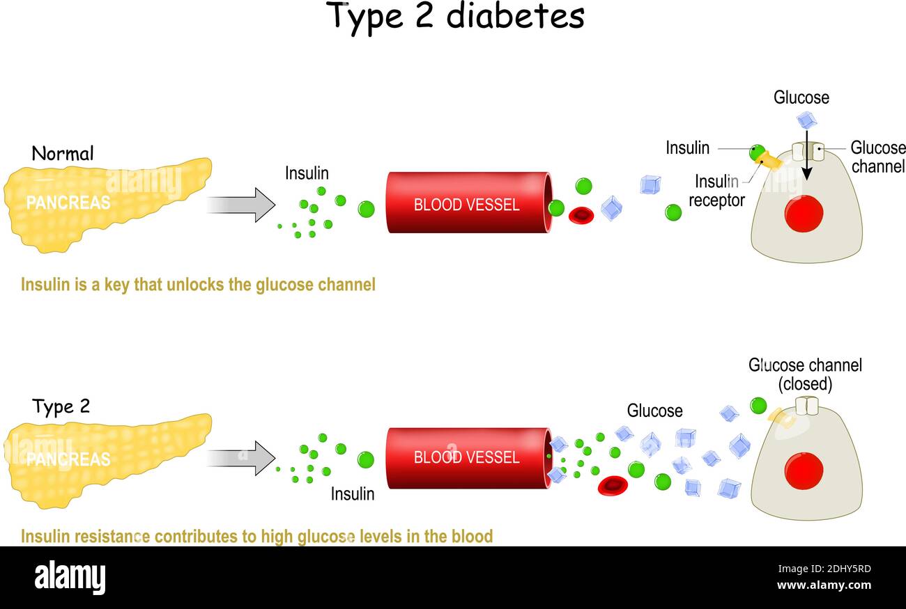 Typ 2 des Diabetes mellitus. Vergleich der Zellarbeit bei Diabetes und in einem gesunden Körper. Insulinresistenz trägt zu hohen Glukosewerten bei Stock Vektor