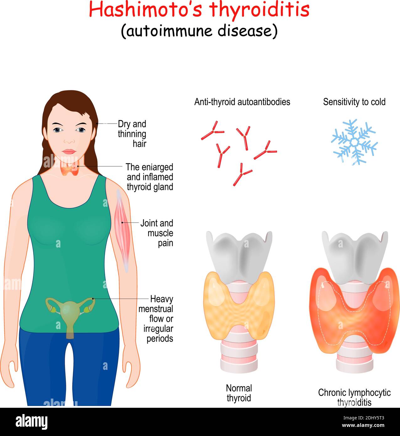 Hashimoto-Thyreoiditis. Chronische lymphatische Thyreoiditis ist eine Autoimmunerkrankung, bei der die Schilddrüse allmählich zerstört wird Stock Vektor