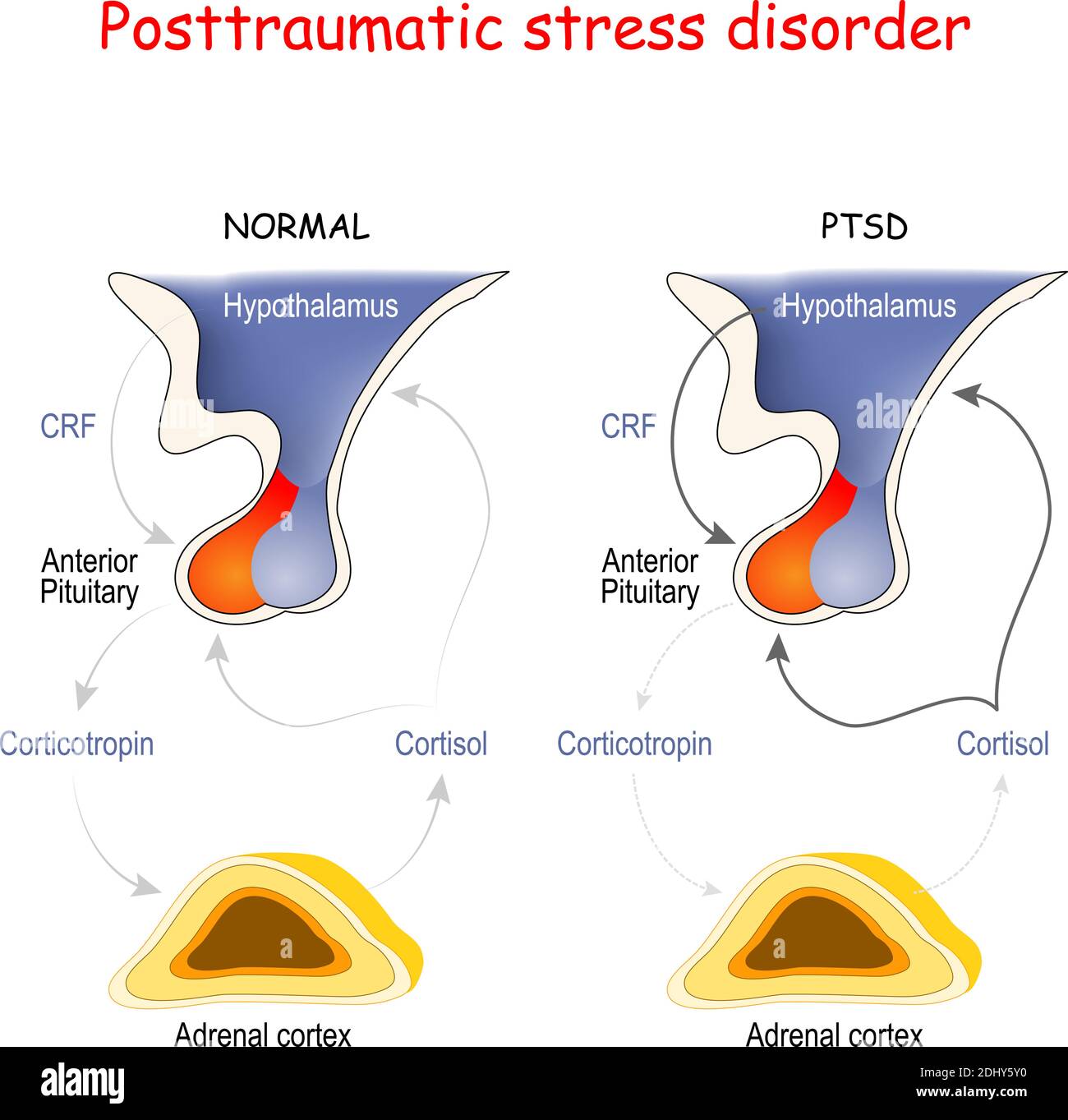 Posttraumatische Belastungsstörung. Nebennierenrinde, Hypophyse und Hypothalamus. Regionen des Gehirns, die mit Stress und PTSD assoziiert sind. Stock Vektor