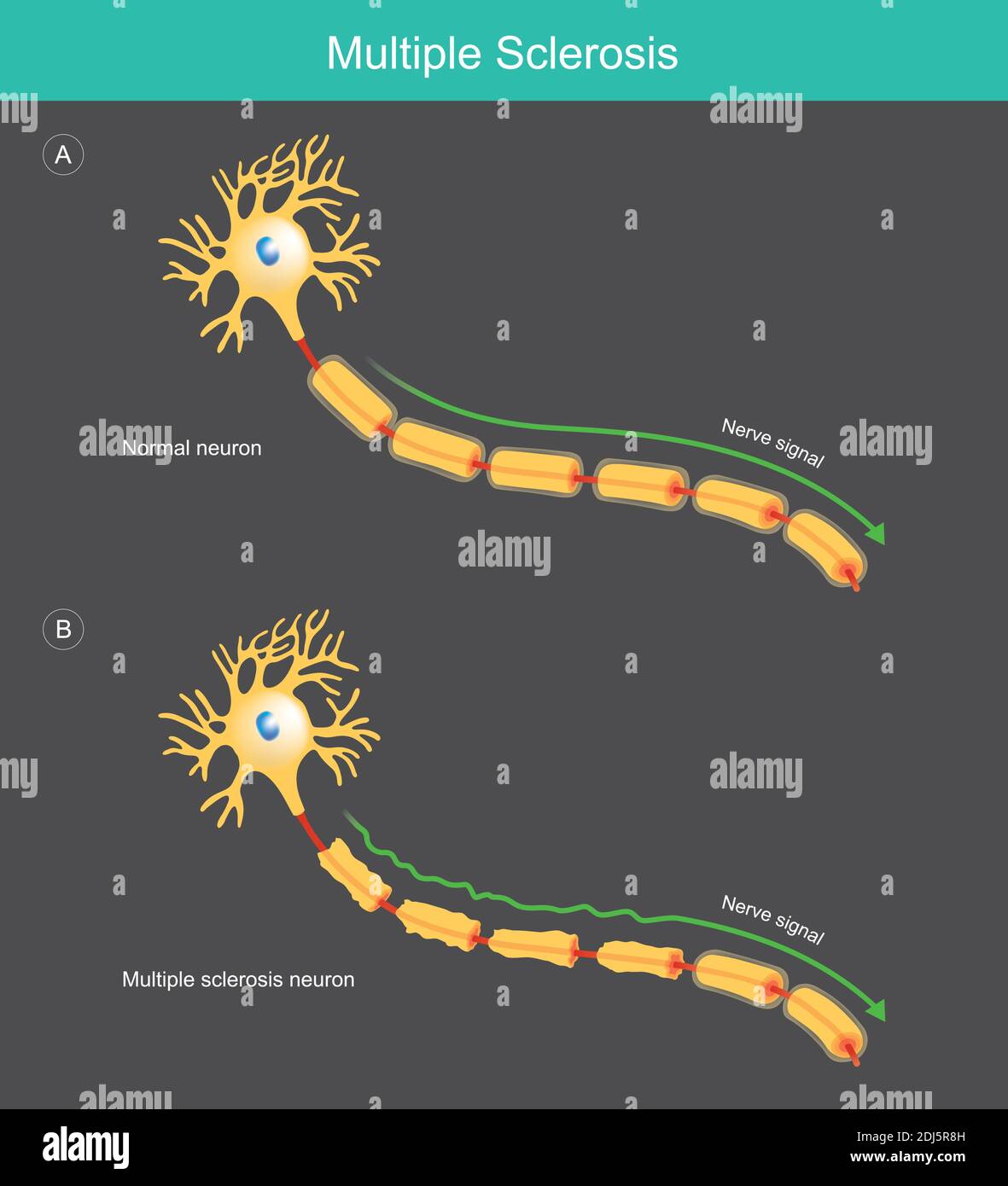 Multiple Sklerose. Illustration in der medizinischen Ausbildung für erklären über ein Signal abnorm verlangsamte Nachricht der Nervenzelle beim Menschen. Stock Vektor