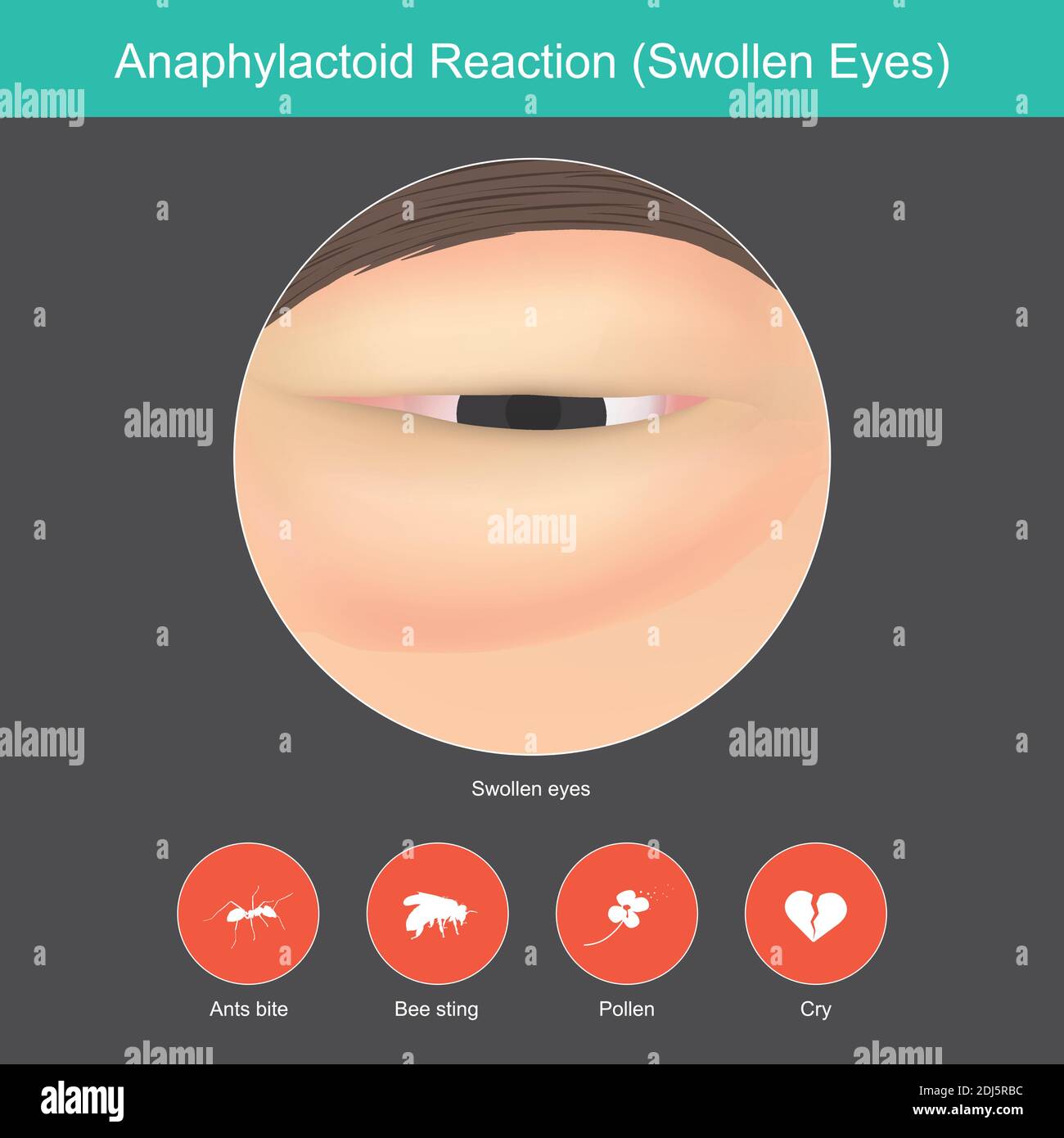 Anaphylaktoide Reaktion. Abbildung zeigen Nahaufnahme um das Auge von einem Symptome in Reaktion auf die Reaktion des Immunsystems. Stock Vektor Anaphylaktoide Reaktion. Abbildung zeigen Nahaufnahme um das Auge von einem Symptome in Reaktion auf die Reaktion des Immunsystems. Stock Vektor