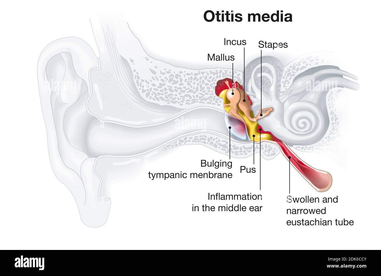 Medizinisch Illustration zeigt Entzündung des Mittelohrs, Otitis media Stockfoto
