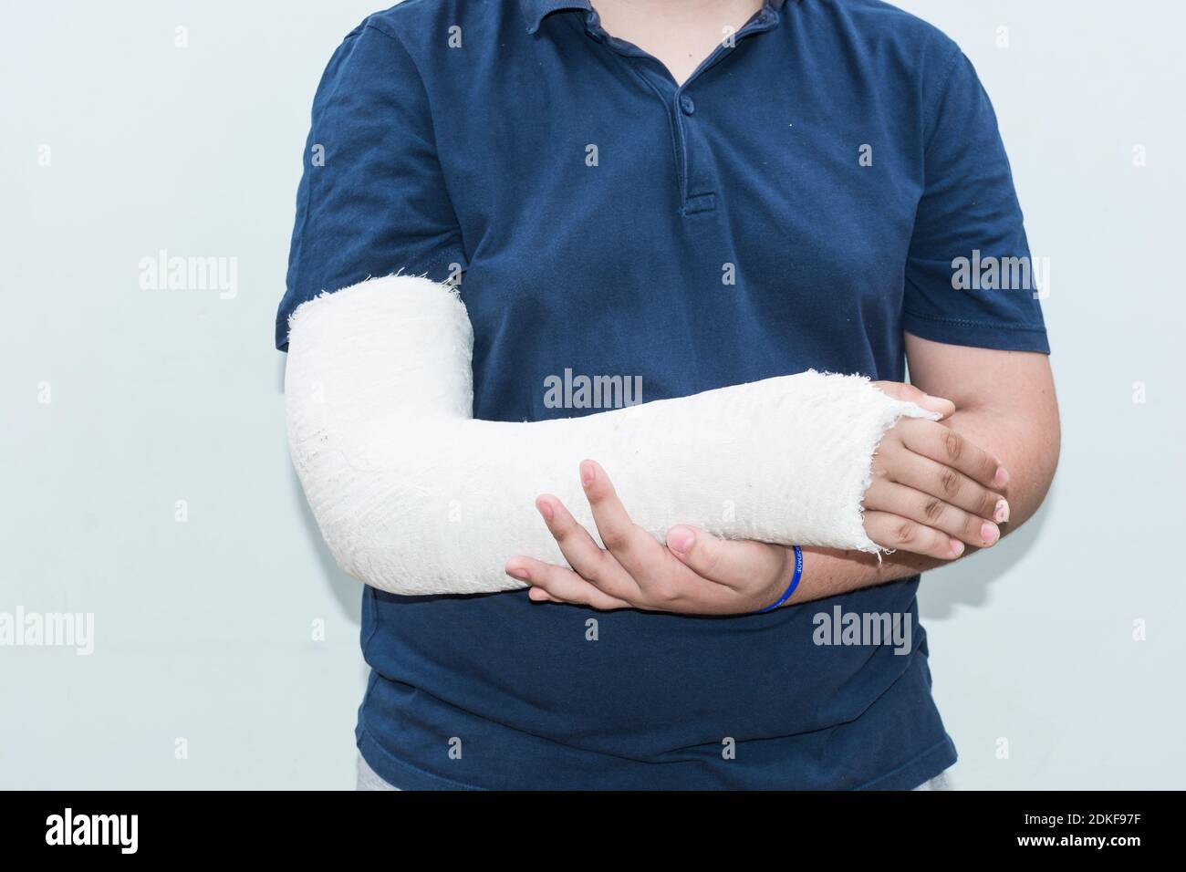 Boy broken arm in plaster Fotos und Bildmaterial in hoher Auflösung