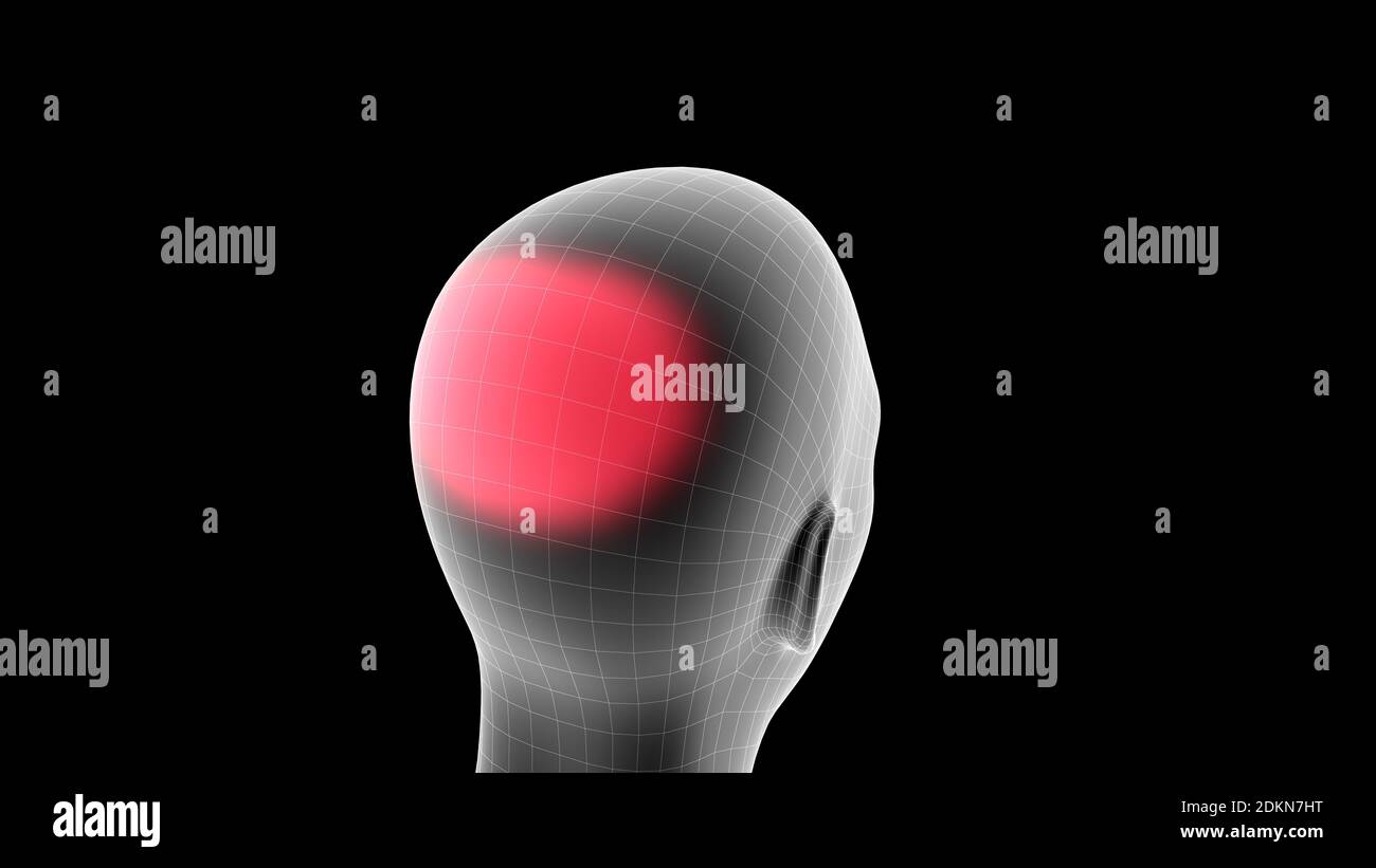 3d-Darstellung eines Frauen-Röntgenhologramms mit Schmerzbereich Im Kopfbereich Stockfoto