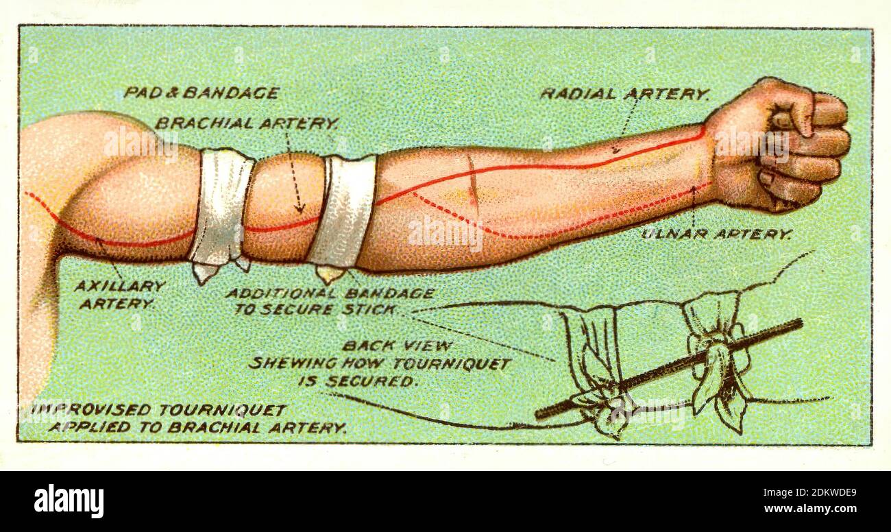 Arteria brachialis Fotos und Bildmaterial in hoher Auflösung Alamy