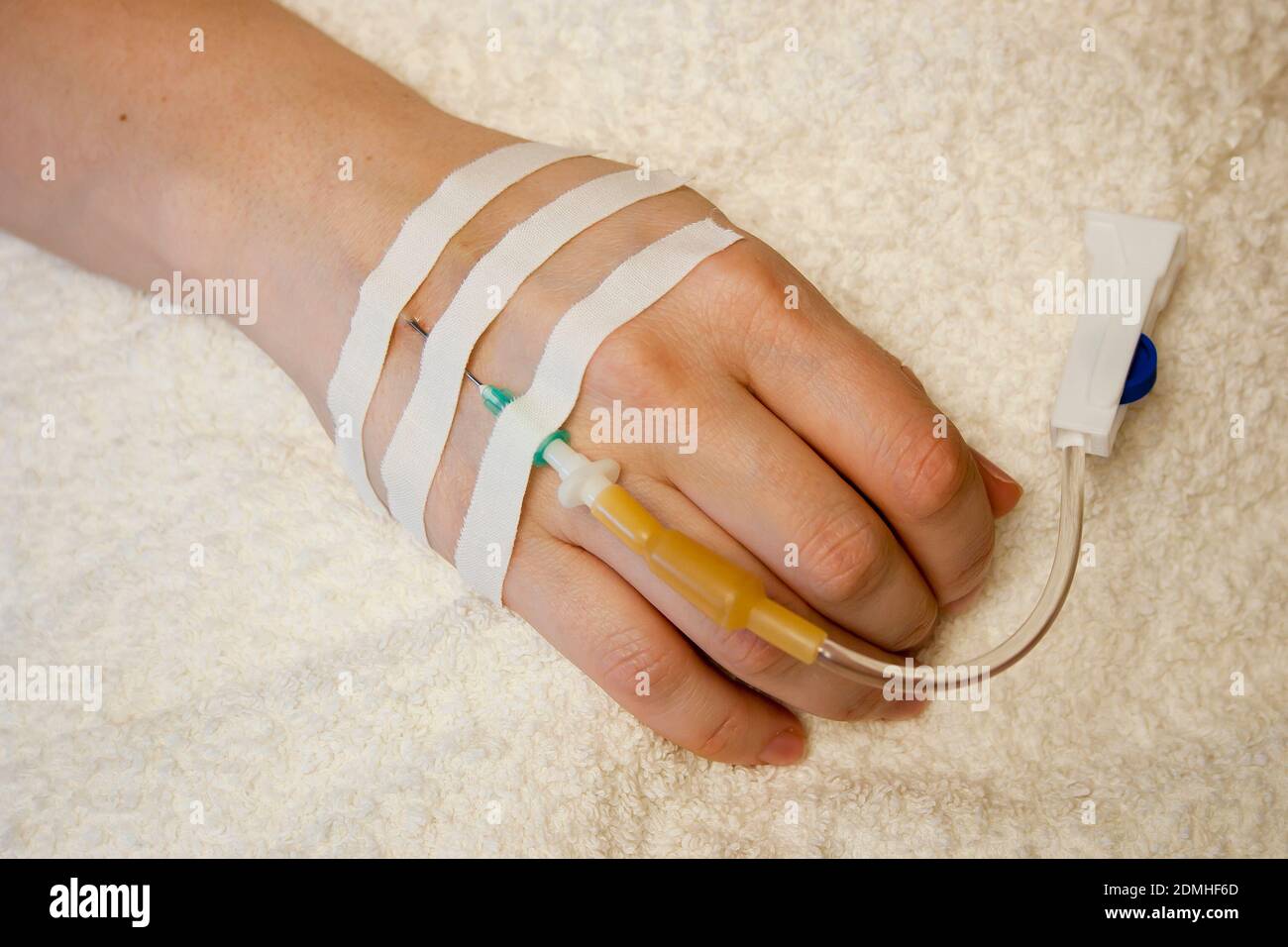 Intravenöse Infusion. Infusionstherapie. Weibliche Hand und Pipettennadel in einer Vene. Intravenöse Infusion ist eine medizinische Manipulation Stockfoto