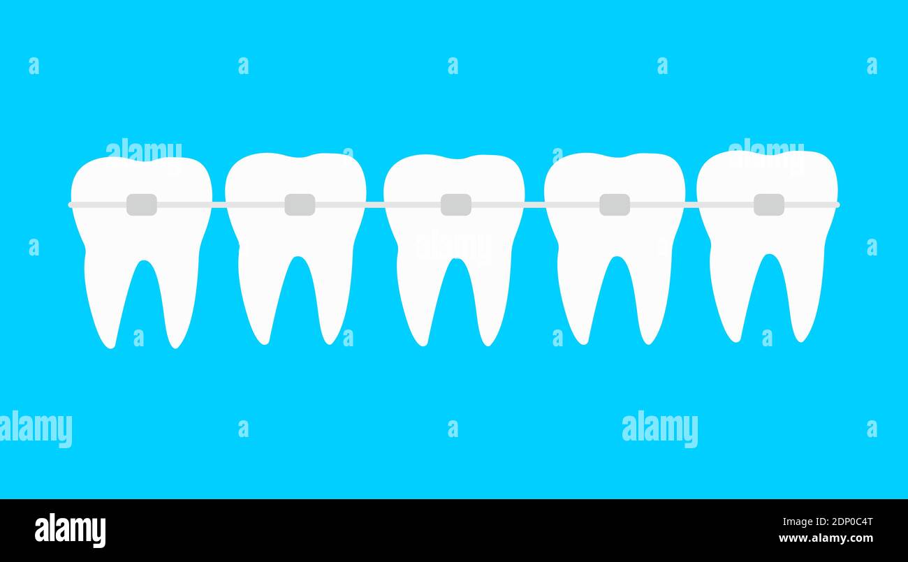 Fünf Zähne mit Zahnspangen Vektor-Illustration. Kieferorthopädische Behandlung Stock Vektor