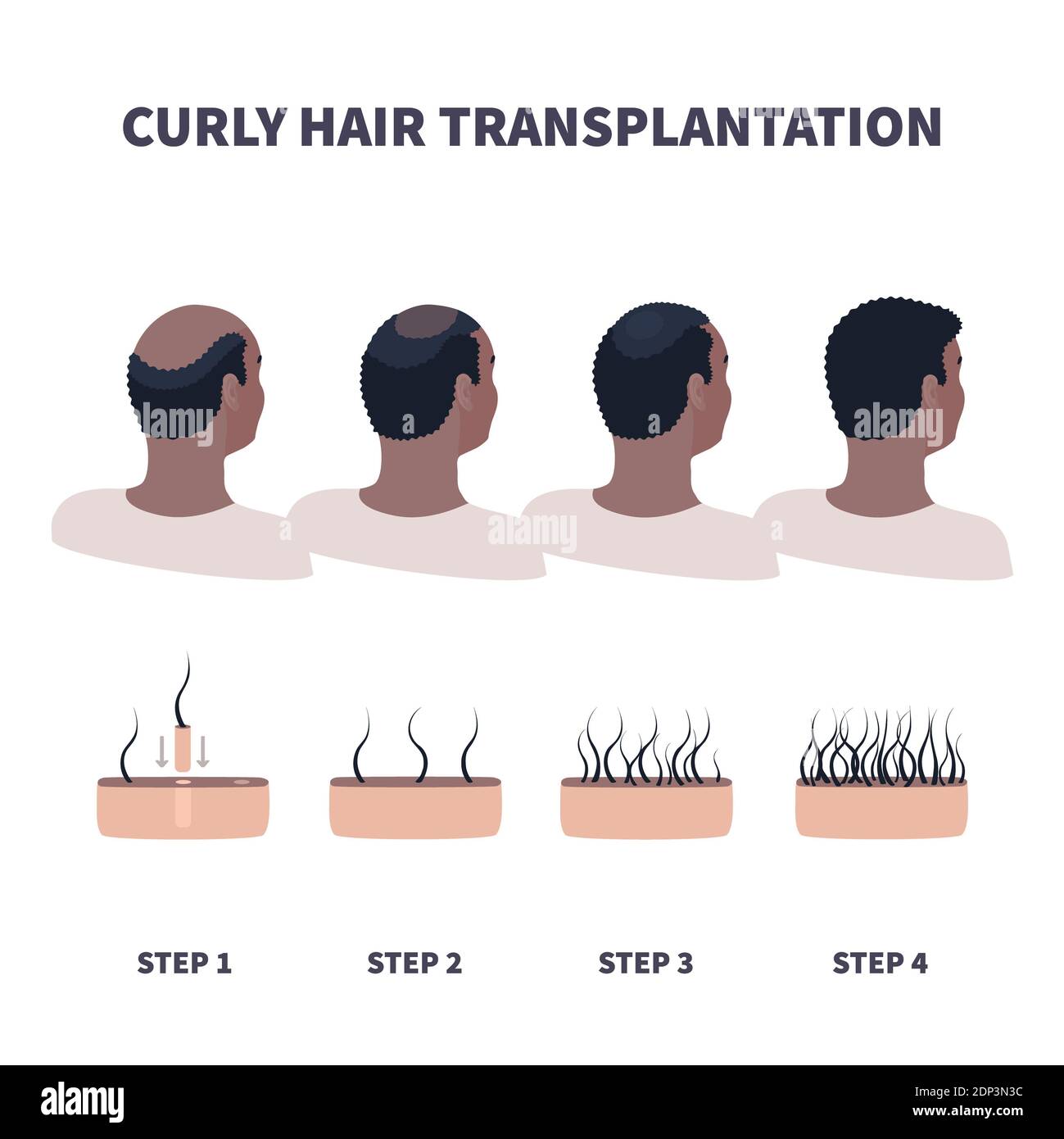 Haartransplantation, Illustration. Stockfoto