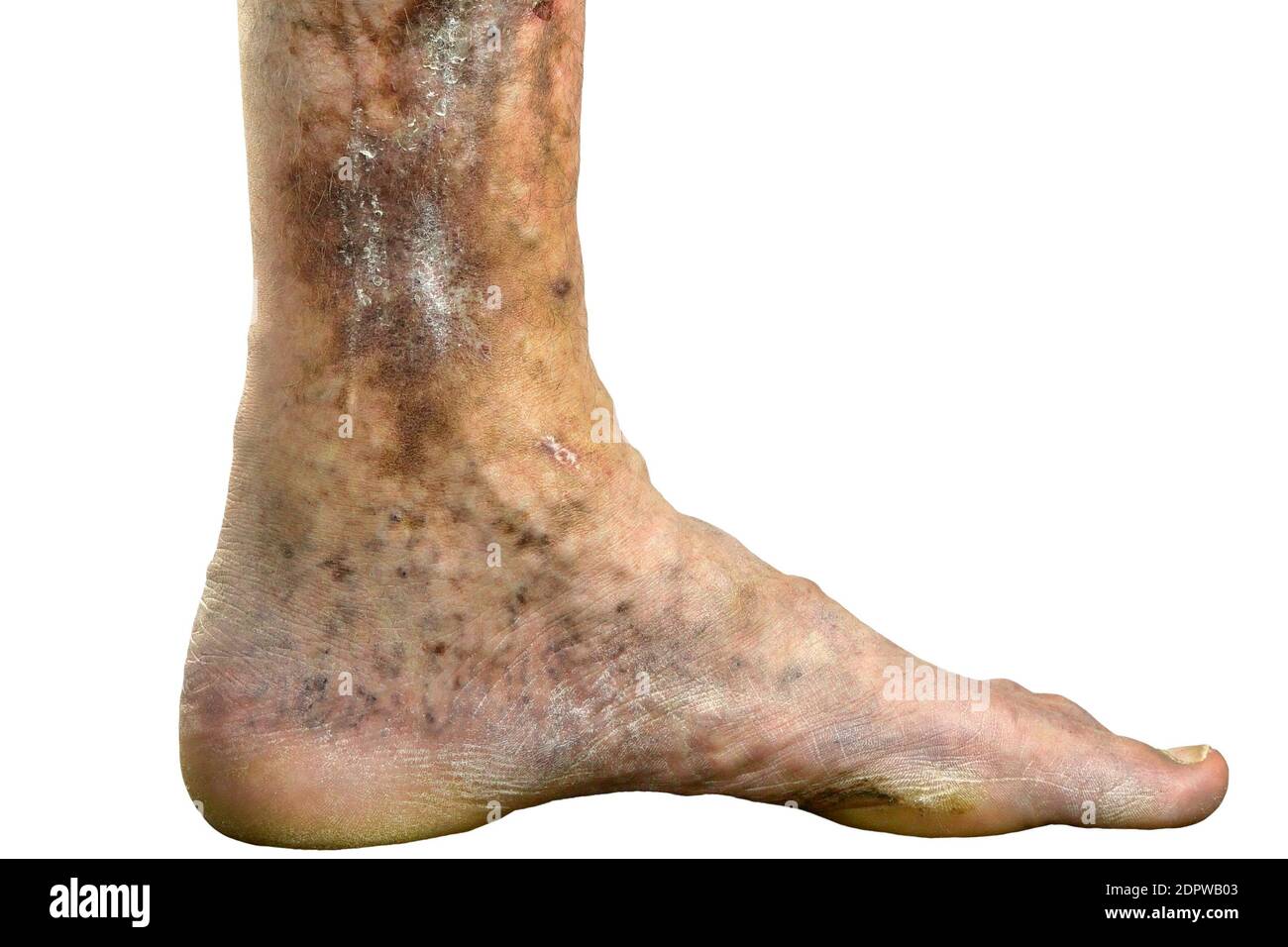 Wunde spotty Bein der Person, leiden an Verstopfung der Venen, Geschwüre, Dermatitis, Ekzeme oder andere Infektionskrankheiten der Dermatologie. Ausschneiden. Isoliert Stockfoto