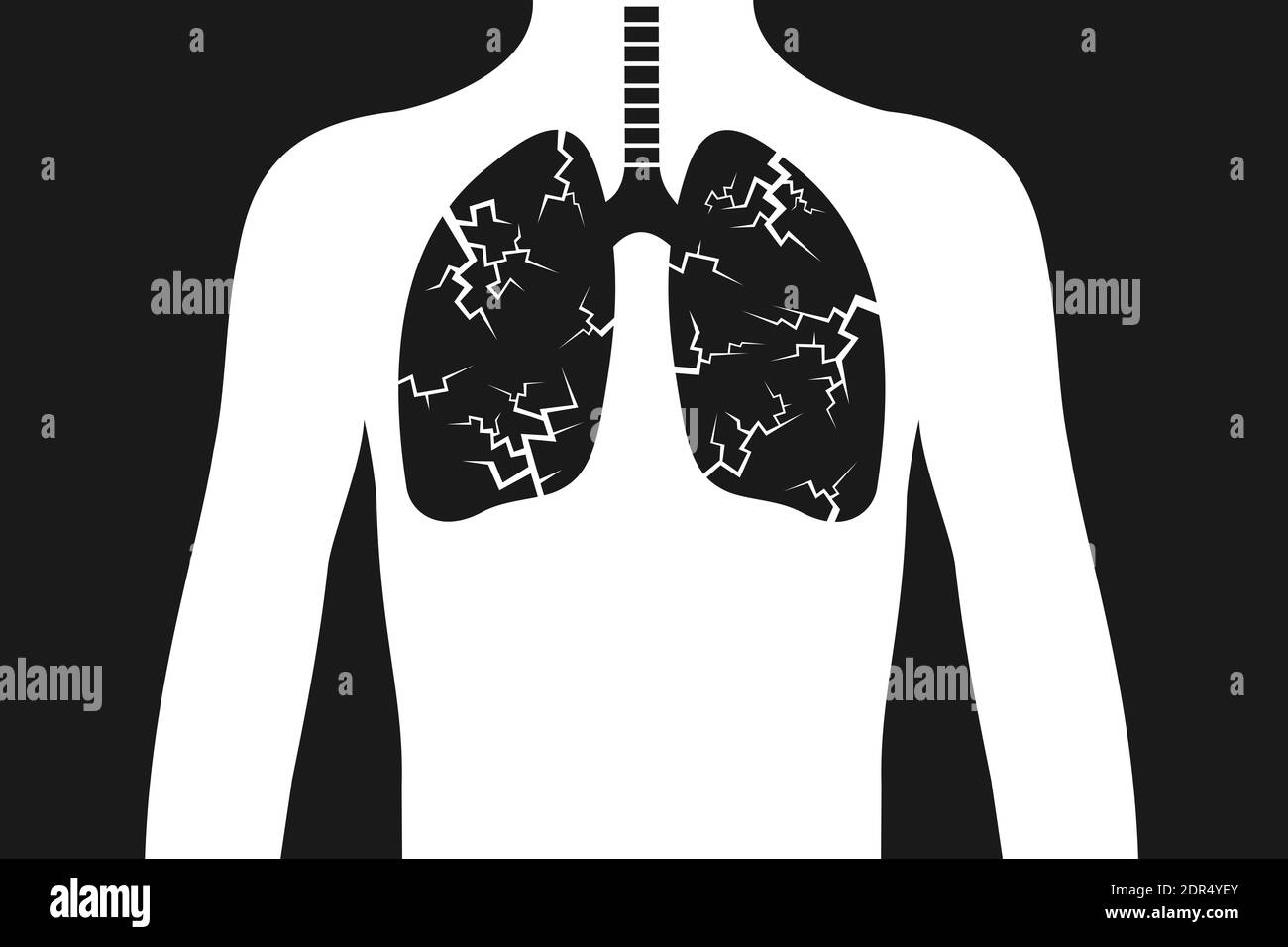 Lungenentzündung und Lungenkrebs - Krankheit und Krankheit schädigt das innere Organ im menschlichen Körper. Gesundheitsproblem auf der Grundlage von Infektion, Virus, Bakterien, Tumor und Stockfoto