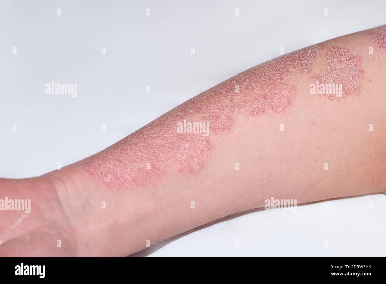 Ekzem Hautkrankheit Psoriasis auf der männlichen Hand.männliche Hand mit Psoriasis-Krankheit. Das medizinische Problem ist Psoriasis. Stockfoto