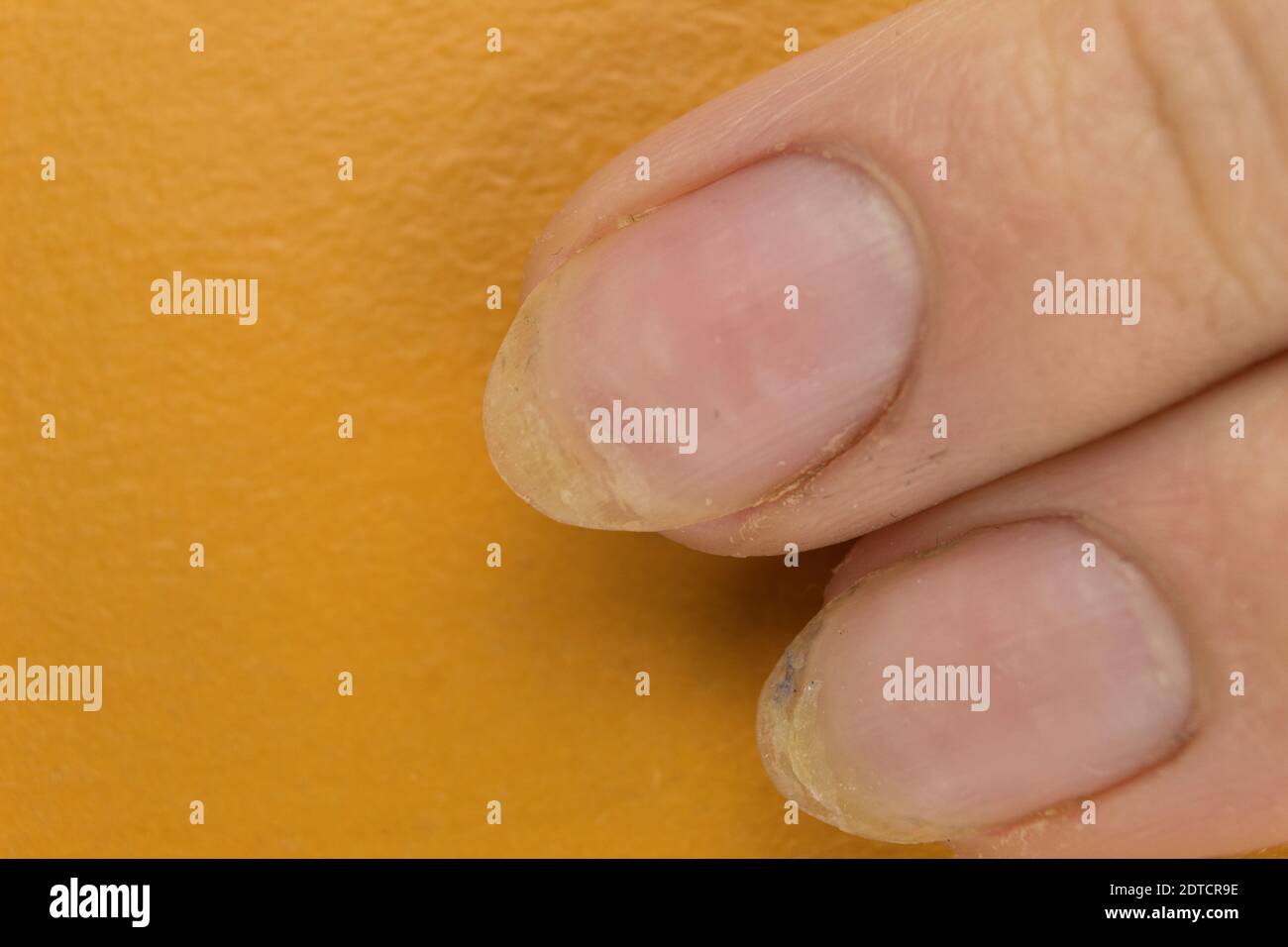 Onychomykose einer Nagelkrankheit, bei der die Nägel sich abpeeln Stockfoto