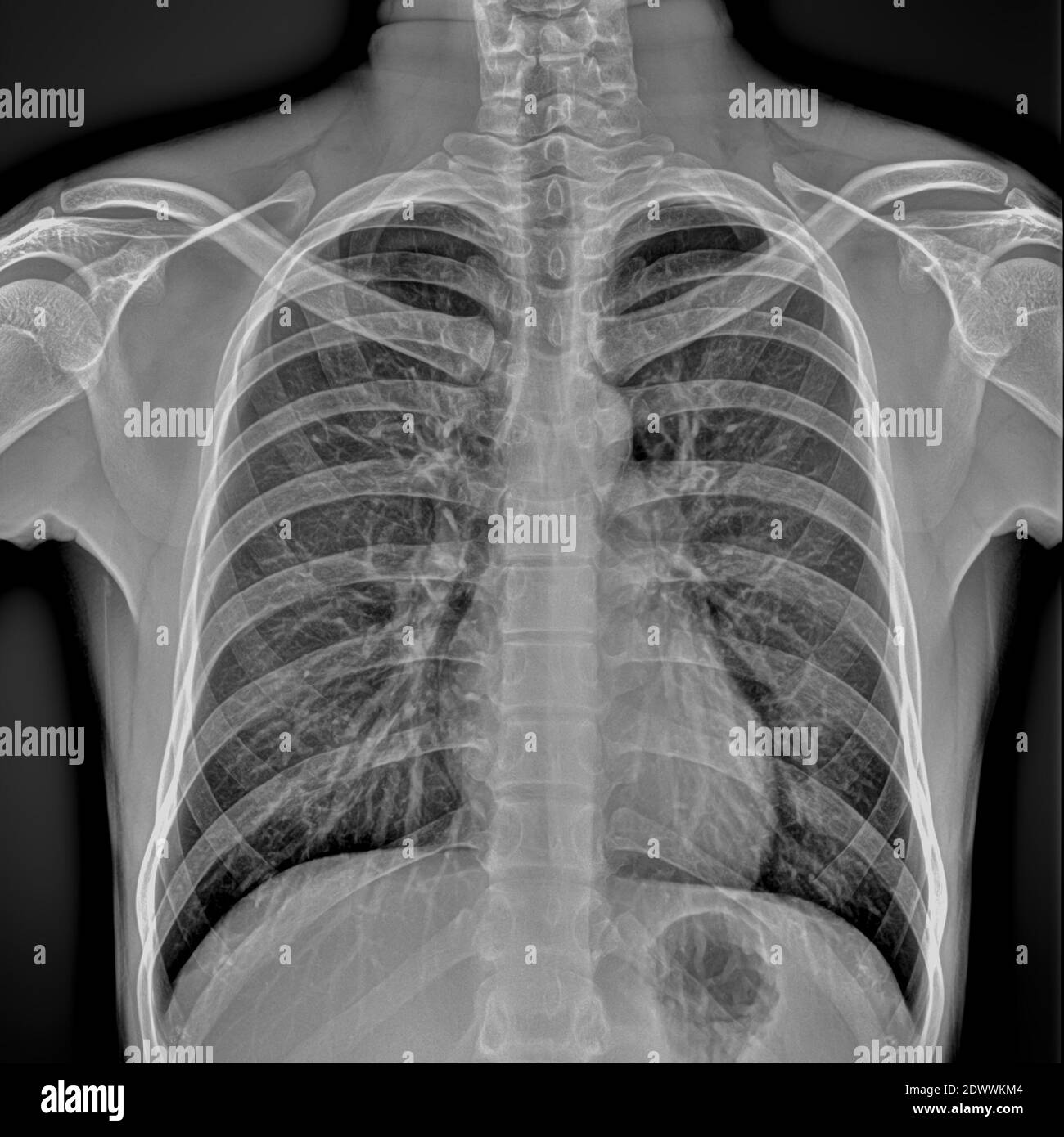Thoraxradiographie eines Krankenhauspatienten Stockfoto